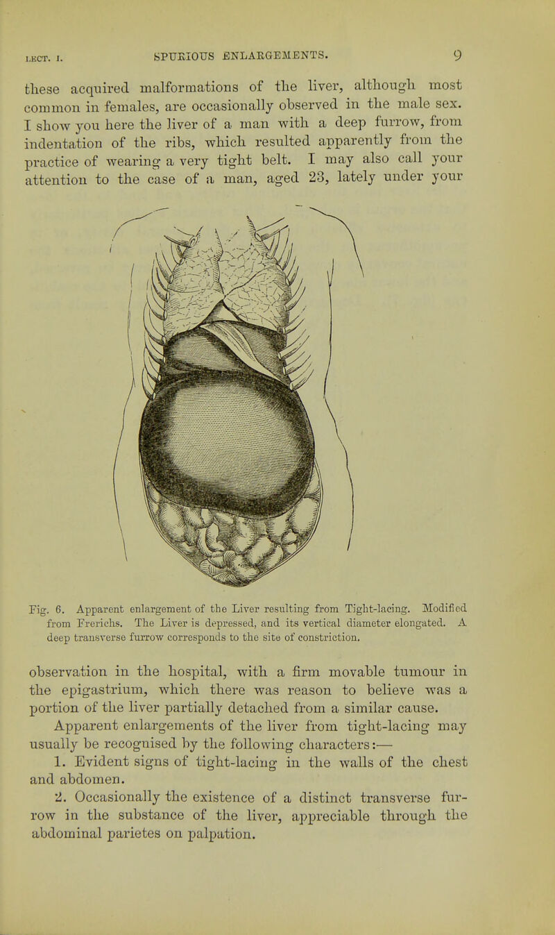 these acquired malformations of the liver, although most common in females, are occasionally observed in the male sex. I show you here the liver of a man with a deep furrow, from indentation of the ribs, which resulted apparently from the practice of wearing a very tight belt. I may also call your attention to the case of a man, aged 23, lately under your Fig. 6. Apparent enlargement of the Liver resulting from Tight-lacing. Modified from Frerichs. The Liver is depressed, and its vertical diameter elongated. A deep transverse furrow corresponds to the site of constriction. observation in the hospital, with a firm movable tumour in the epigastrium, which there was reason to believe was a portion of the liver partially detached from a similar cause. Apparent enlargements of the liver from tight-lacing may usually be recognised by the following characters:— 1. Evident signs of tight-lacing in the walls of the chest and abdomen. 2. Occasionally the existence of a distinct transverse fur- row in the substance of the liver, appreciable through the abdominal parietes on palpation.