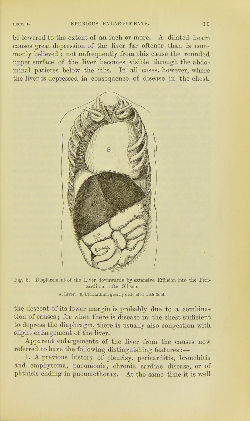 be lowered to tlie extent of an incli or more. A dilated heart causes great depression of tlie liver far oftener than is com- monl}'- believed ; not unfrequently from this cause the rounded upper surface of the liver becomes visible through the abdo- minal parietes below the ribs. In all cases, however, where the liver is depressed in consequence of disease in the chest, Fig. 8. Displacement of the Liver downwards by extensive Effusion into tlie Peri- cardium : after Sibson. A, Liver, b, Pericardium greatly distended vnth fluid. the descent of its lower margin is probably due to a combina- tion of causes; for when there is disease in the cheat sufficient to depress the diaphragm, there is usually also congestion with slight enlargement of the liver. Apparent enlargements of the liver from the causes noAV referred to have the following distinguishing features : — 1. A previous history of pleurisy, pericarditis, bronchitis and emphysema, pneumonia, chronic cardiac disease, or of phthisis ending in pneumothorax. At the same time it is well