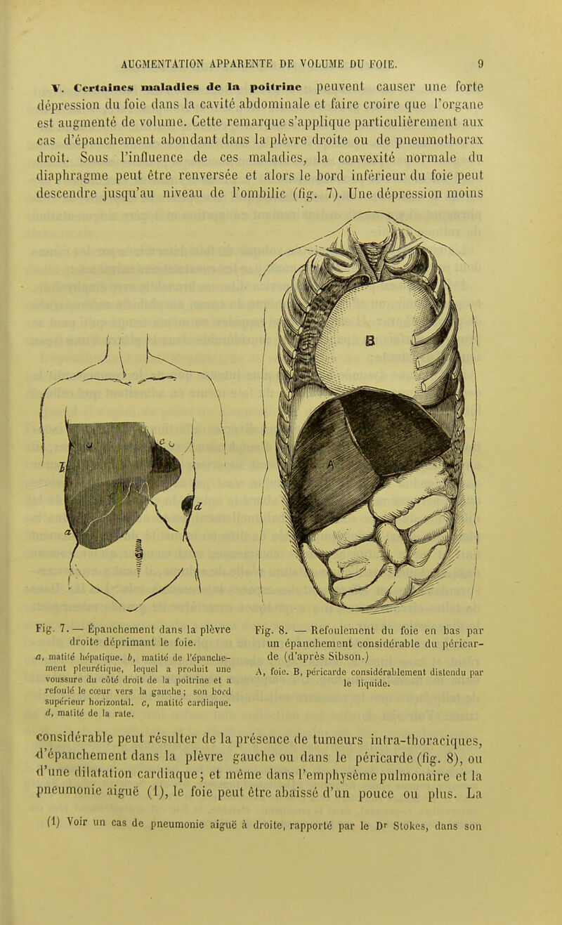 V. Certaines maladies de la poitrine peuvent Causer une forte dépression du foie dans la cavité abdominale et faire croire que l'organe est augmenté de volume. Cette remarque s'applique particulièrement aux cas d'épanchement abondant dans la plèvre droite ou de pneumotborax droit. Sous l'influence de ces maladies, la convexité normale du diaphragme peut être renversée et alors le bord inférieur du foie peut descendre jusqu'au niveau de l'ombilic (fig. 7). Une dépression moins Fig. 7.— Épaiichement dans la plèvre droite déprimant le foie. a, matilé litîpaliquc. h, nialitii de répanclie- mcnt picurélique, lequel a produit une voussure du côtd droit de la poitrine et a refoulé le cœur vers la gauclio ; son bord supérieur horizontal, c, malité cardiaque. d, matilé de la raie. Fig. 8. — Refoulement du foie en bas par un épanchement considérable du péricar- de (d'après Sibson.) A, foie. B, péricarde considérablement distendu par le liquide. considérable peut résulter de la présence de tumeurs inira-tboraciques, <répancbement dans la plèvre gauche ou dans le péricarde (fig. 8), ou d'une dilatation cardiaque; et même dans l'emphysème pulmonaire et la pneumonie aiguë (1), le foie peut être abaissé d'un pouce ou plus. La (1) Voir un cas de pneumonie aiguë à droite, rapporté par le D' Stokes, dans son