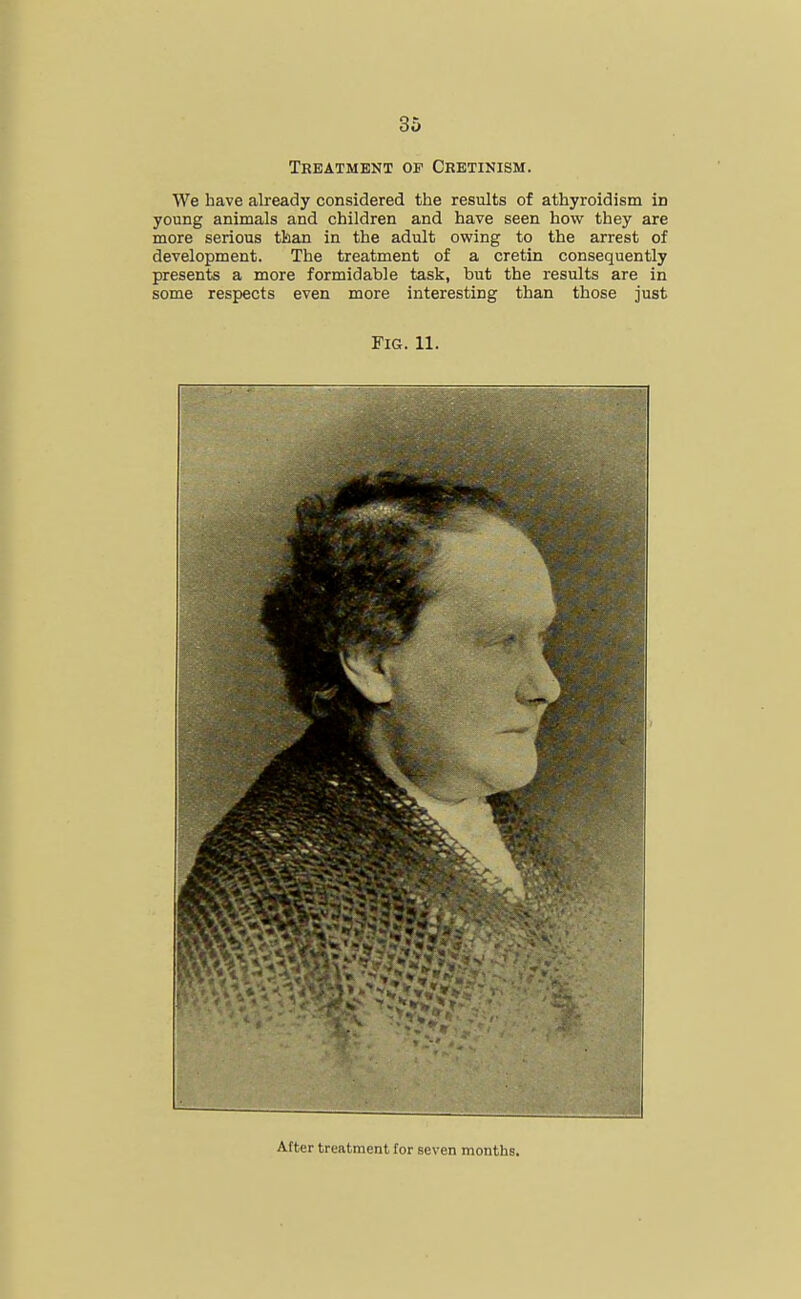 Treatment of Cretinism. We have already considered the results of athyroidism id young animals and children and have seen how they are more serious than in the adult owing to the arrest of development. The treatment of a cretin consequently presents a more formidable task, but the results are in some respects even more interesting than those just Fig. 11. After treatment for seven months.