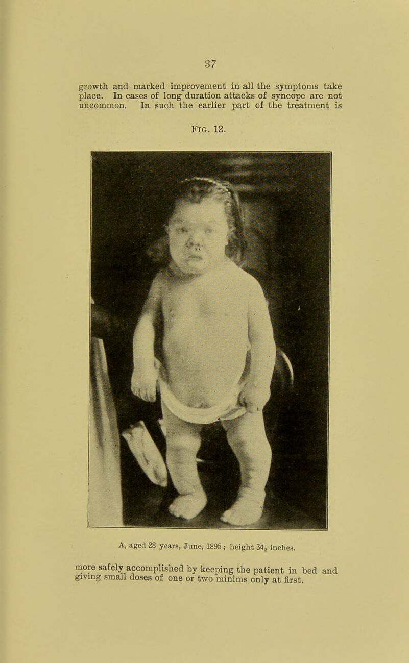 growth and marked improvement in all the symptoms take place. In cases of long duration attacks of syncope are not uncommon. In such the earlier part of the treatment is Fig. 12. A, aged 28 years, June, 1895; height 34i inches. more safely accomplished by keeping the patient in bed and givmg small doses of one or two minims only at first.