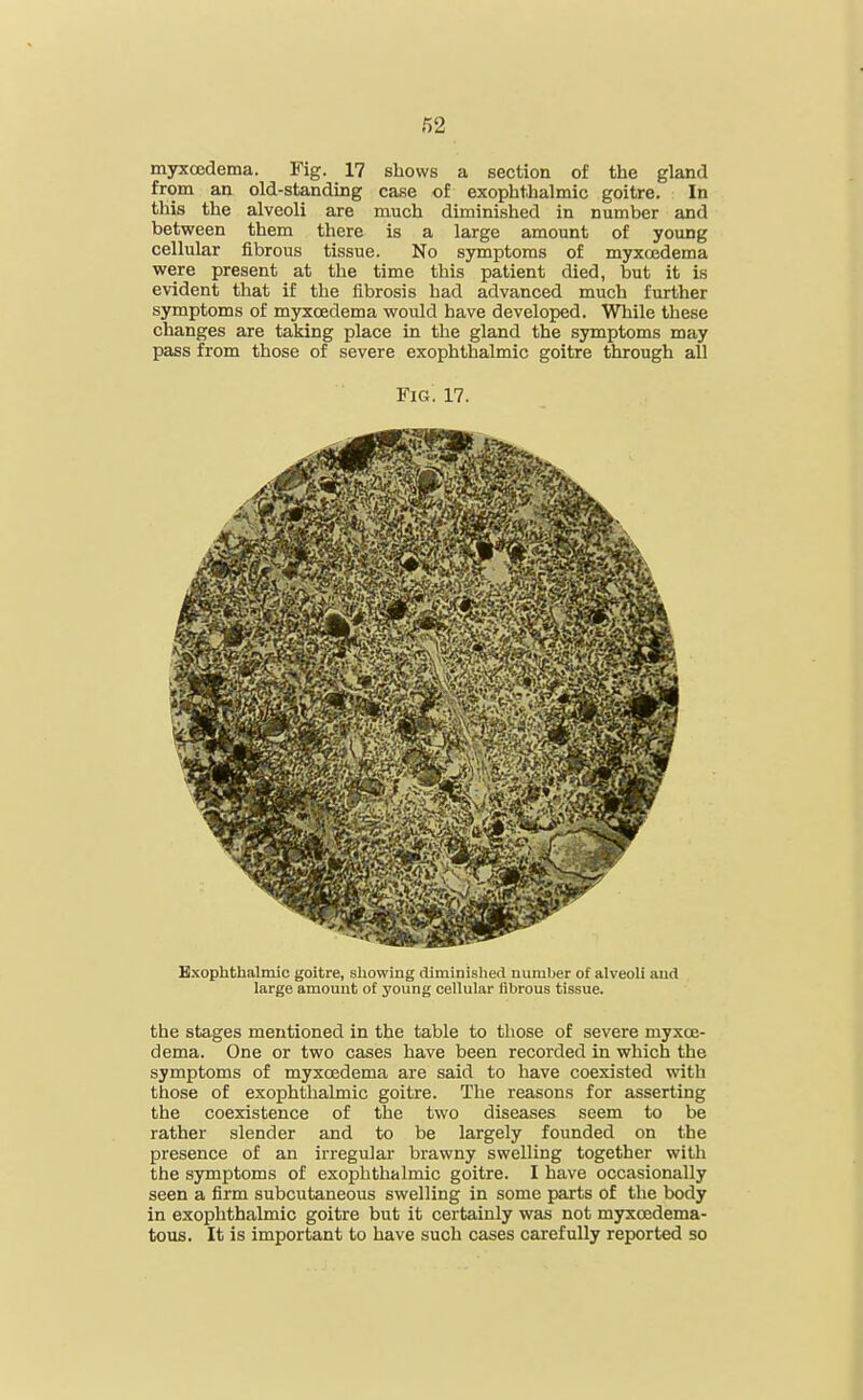 myxcedema. Fig. 17 shows a section of the gland from an old-standing case of exophthalmic goitre. In this the alveoli are much diminished in number and between them there is a large amount of young cellular fibrous tissue. No symptoms of myxcedema were present at the time this patient died, but it is evident that if the fibrosis had advanced much further symptoms of myxcedema would have developed. While these changes are taking place in the gland the symptoms may pass from those of severe exophthalmic goitre through all Fig. 17. Exophthalmic goitre, showing diminished number of alveoli and large amount of young cellular fibrous tissue. the stages mentioned in the table to those of severe myxce- dema. One or two cases have been recorded in which the symptoms of myxcedema are said to have coexisted with those of exophthalmic goitre. The reasons for asserting the coexistence of the two diseases seem to be rather slender and to be largely founded on the presence of an irregular brawny swelling together with the symptoms of exophthalmic goitre. I have occasionally seen a firm subcutaneous swelling in some parts of the body in exophthalmic goitre but it certainly was not myxcedema- tous. It is important to have such cases carefully reported so