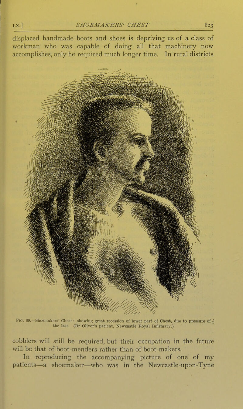 displaced handmade boots and shoes is depriving us of a class of workman who was capable of doing all that machinery now accomplishes, only he required much longer time. In rural districts Fio. 89.—Shoemakers’ Chest: showing great recession of lower part of Chest, due to pressure of 0 the last. (Dr Oliver’s patient, Newcastle Royal Infirmary.) cobblers will still be required, but their occupation in the future will be that of boot-menders rather than of boot-makers. In reproducing the accompanying picture of one of my patients—a shoemaker—who was in the Newcastle-upon-Tyne