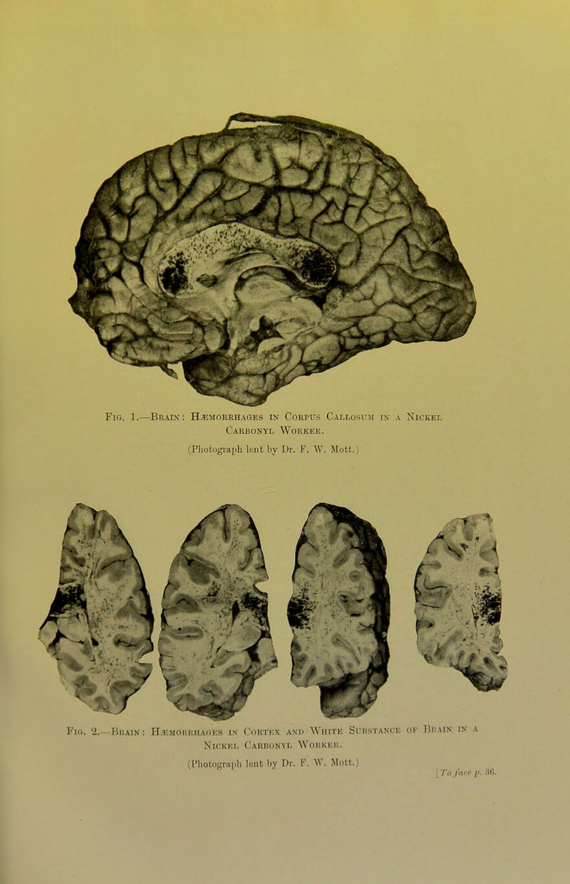Fig. 1.—Brain: Hemorrhages in Corpus Callosum in a Nickel Carbonyl Worker. (Photograph lent by Dr. F. W. Mott.) Fig. 2.—Brain: H^-.mohuuagks in Cortex and White Substance ok Brain in a Nickel Carbonyl Worker. (Photograph lent by Dr. F. W. Mott.) iToj'nrc i>. 'M\.