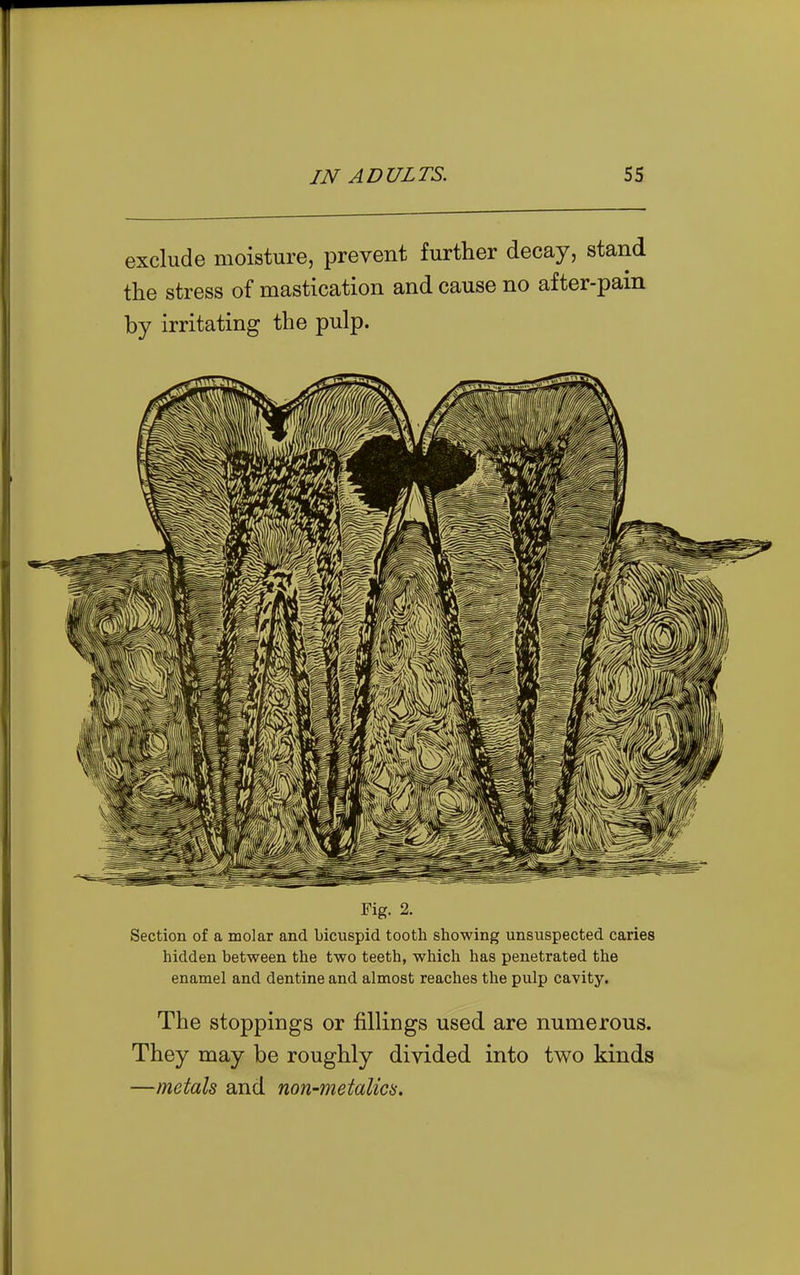 exclude moisture, prevent further decay, stand the stress of mastication and cause no af ter-pam by irritating the pulp. Fig. 2. Section of a molar and bicuspid tooth showing unsuspected caries hidden between the two teeth, which has penetrated the enamel and dentine and almost reaches the pulp cavity. The stoppings or fillings used are numerous. They may be roughly divided into two kinds —metals and non-metalics.