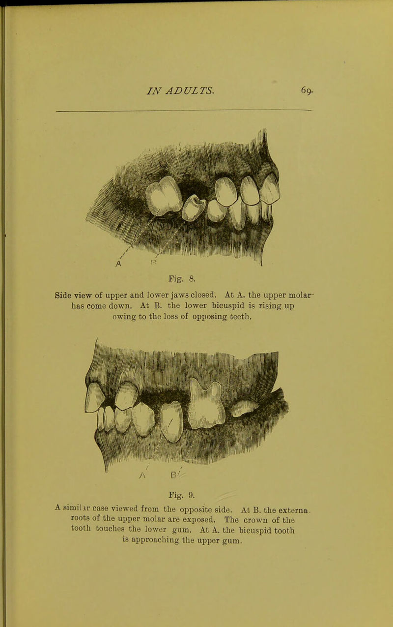 Fig. 8. Side view of upper and lower jaws closed. At A. the upper molar- has come down. At B. the lower bicuspid is rising up owing to the loss of opposing teeth. Fig. 9. A similir case viewed from the opposite side. At B. the externa, roots of the upper molar are exposed. The crown of the tooth touches the lower gum. At A. the bicuspid tooth is approaching the upper gum.