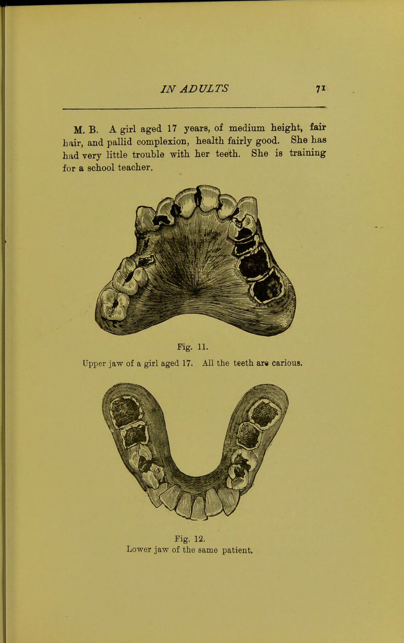 M. B. A girl aged 17 years, of medium height, fair Lair, and pallid complexion, health fairly good. She has had very little trouble with her teeth. She is training for a school teacher. Fig. 11. Upper jaw of a girl aged 17. All the teeth are carious. Fig. 12. Lower jaw of the same patient.