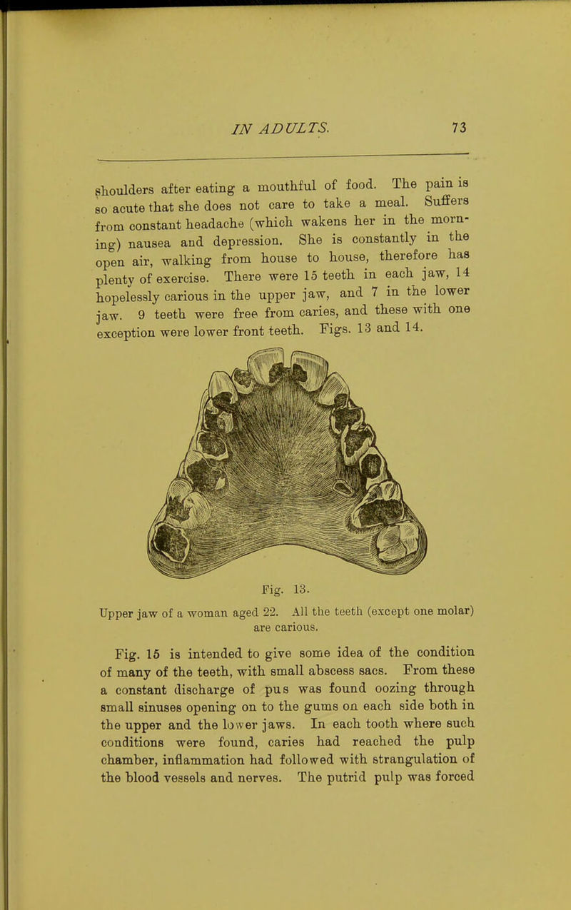 shoulders after eating a mouthful of food. The pain is so acute that she does not care to take a meal. Suffers from constant headache (which wakens her in the morn- ing) nausea and depression. She is constantly in the open air, walking from house to house, therefore has plenty of exercise. There were 15 teeth in each jaw, 14 hopelessly carious in the upper jaw, and 7 in the lower jaw. 9 teeth were free from caries, and these with one exception were lower front teeth. Figs. 13 and 14. Upper jaw of a woman aged 22. All the teeth (except one molar) are carious. Fig. 16 is intended to give some idea of the condition of many of the teeth, with small abscess sacs. From these a constant discharge of pus was found oozing through small sinuses opening on to the gums on each side both in the upper and the lower jaws. In each tooth where such conditions were found, caries had reached the pulp chamber, inflammation had followed with strangulation of the blood vessels and nerves. The putrid pulp was forced