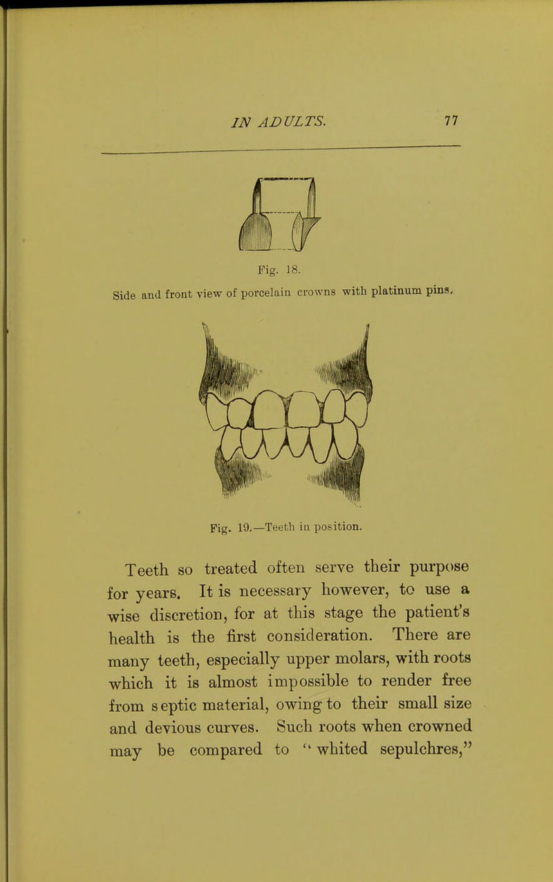 Fig. 18. Side and front view of porcelain crowns with platinum pins< Fig. 19.—Teeth iu position. Teeth so treated often serve their purpose for years. It is necessary however, to use a wise discretion, for at this stage the patient's health is the first consideration. There are many teeth, especially upper molars, with roots which it is almost impossible to render free from s eptic material, owing to their small size and devious curves. Such roots when crowned may be compared to whited sepulchres,