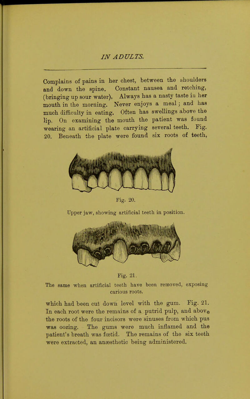 Complains of pains in her chest, between the bhoulders and down the spine. Constant nausea and retching, (bringing up sour water), Always has a nasty taste iu her mouth in the morning. Never enjoys a meal; and has much difficulty in eating. Often has swellings above the lip, On examining the mouth the patient was found wearing an artificial plate carrying several teeth. Fig. 20. Beneath the plate were found six roots of teeth, Fig. 20. Upper jaw, showing artificial teeth in position. Fig. 21. The same when artificial teeth have been removed, exposing carious roots. which had been cut down level with the gum. Fig. 21. In each root were the remains of a putrid pulp, and above the roots of the four incisors were sinuses from which pus was oozing. The gums were much inflamed and the patient's breath was foetid. The remains of the six teeth were extracted, an ansesthetic being administered.