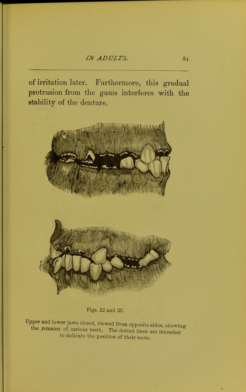 of irritation later. Furthermore, this gradual protrusion from the gums interferes with the stability of the denture. Figs. 22 and 23. Upper and lower jaws closed, viewed from opposite sides, showing the remains of carious teeth. The dotted lines are intended to indicate the position of their roots.