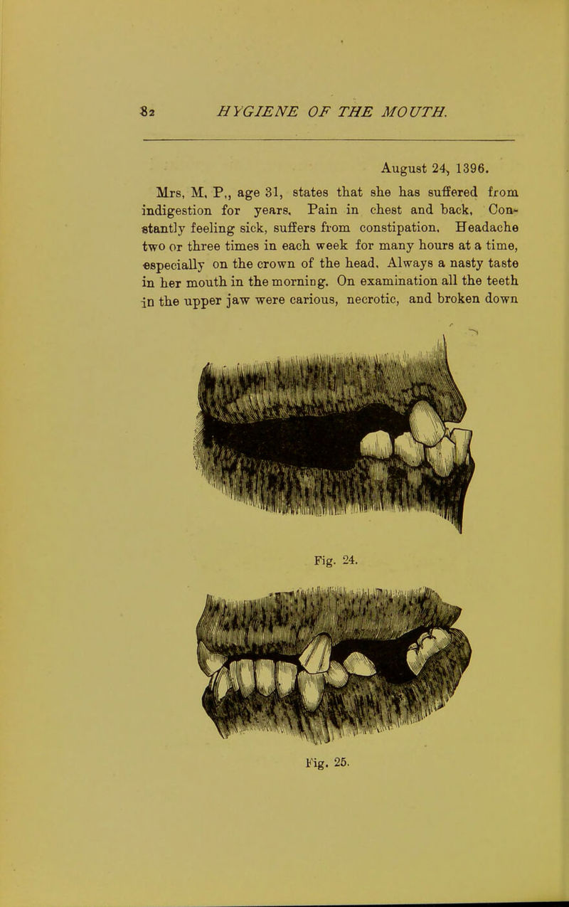 August 24,, 1396. Mrs, M, P,, age 31, states that slie has suffered from indigestion for years. Pain in chest and back, Con- stantly feeling sick, suffers from constipation. Headache two or three times in each week for many hours at a time, ■especially on the crown of the head. Always a nasty taste in her mouth in the morniog. On examination all the teeth in the upper jaw were carious, necrotic, and broken down Fig. 26.