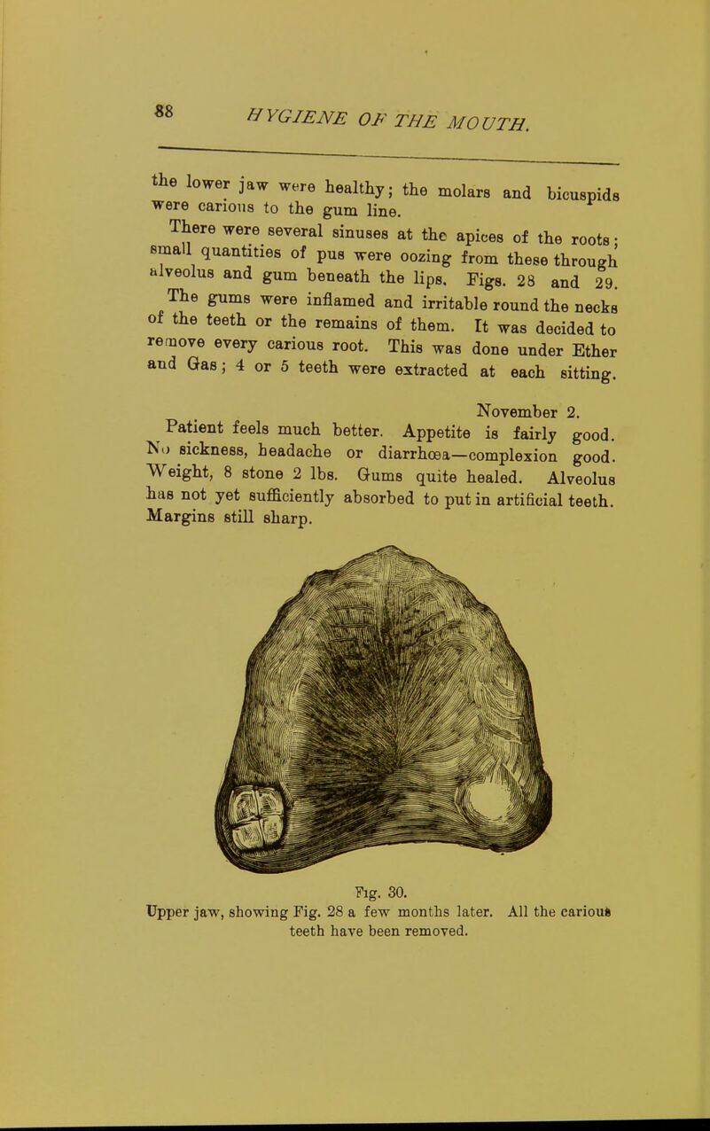 the lower jaw were healthy; the molars and bicuspids were carious to the gum line. There were several sinuses at the apices of the roots • Bmall quantities of pus were oozing from these through alveolus and gum beneath the lips. Figs. 28 and 29. The gums were inflamed and irritable round the necks of the teeth or the remains of them. It was decided to remove every carious root. This was done under Ether and Gas; 4 or 5 teeth were extracted at each sitting. November 2. ^ Patient feels much better. Appetite is fairly good. No sickness, headache or diarrhoea—complexion good. Weight, 8 stone 2 lbs. Gums quite healed. Alveolus has not yet sufficiently absorbed to put in artificial teeth. Margins still sharp. Fig. 30. Upper jaw, showing Fig. 28 a few months later. All the carioufc teeth have been removed.