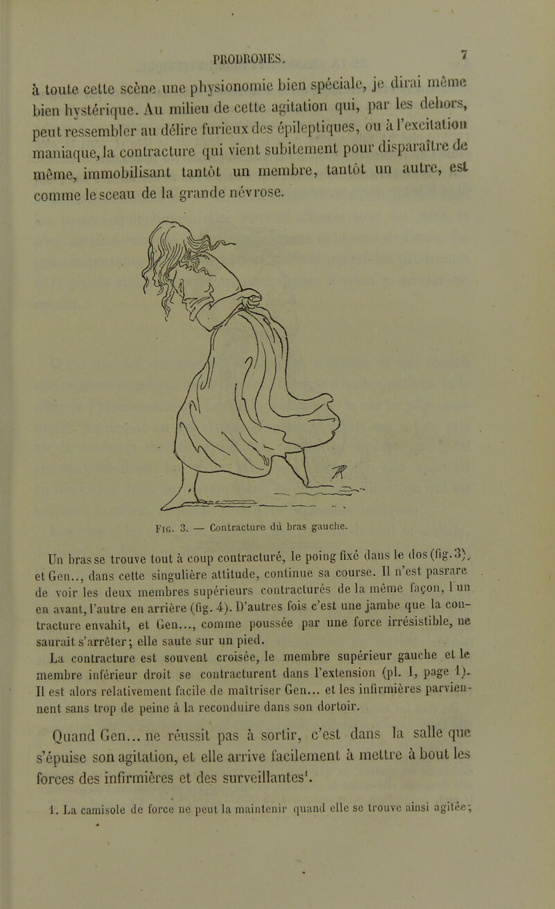 3 à toute cette scène une physionomie bien spéciale, je dirai même bien hystérique. Au milieu de cette agitation qui, par les dehors, peut ressembler au délire furieux des épileptiques, ou à l'excitation maniaque, la contracture qui vient subitement pour disparaître de même, immobilisant tantôt un membre, tantôt un autre, esl comme le sceau de la grande névrose. Un brasse trouve tout à coup contracturé, le poing fixé clans le dos (fig.3), etGen.., dans cette singulière attitude, continue sa course. Il n'est pasrare de voir les deux membres supérieurs contracturés delà même façon, lun en avant, l'autre en arrière (fig. 4). D'autres fois c'est une jambe que la con- tracture envahit, et Gen..., comme poussée par une force irrésistible, ne saurait s'arrêter; elle saute sur un pied. La contracture est souvent croisée, le membre supérieur gauche et le membre inférieur droit se contracturent dans l'extension (pl. I, page 1). Il est alors relativement facile de maîtriser Gen... et les infirmières parvien- nent sans trop de peine à la reconduire dans son dortoir. Quand Gen... ne réussit pas à sortir, c'est dans la salle que s'épuise son agitation, et elle arrive facilement à mettre à bout les forces des infirmières et des surveillantes1. jrIG. 3. — Contracture dû bras gauche. 1. La camisole de force ne peut la maintenir quand elle se trouve ainsi âgîfêe;