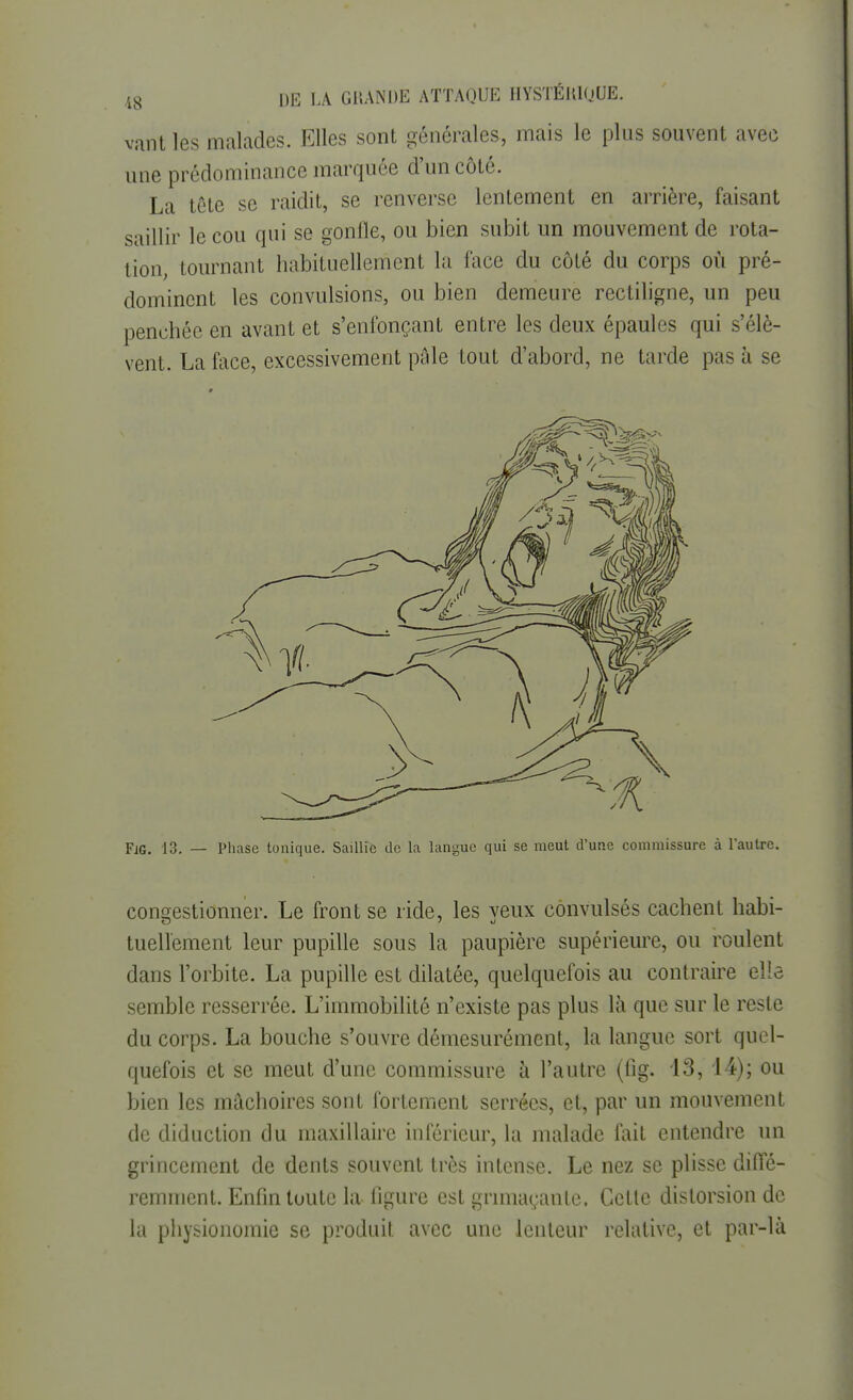 vant les malades. Elles sont générales, mais le plus souvent avec une prédominance marquée d'un côté. La tête se raidit, se renverse lentement en arrière, faisant saillir le cou qui se gonfle, ou bien subit un mouvement de rota- tion, tournant habituellement la face du côté du corps où pré- dominent les convulsions, ou bien demeure rectiligne, un peu penchée en avant et s'enfonçant entre les deux épaules qui s'élè- vent. La face, excessivement pâle tout d'abord, ne tarde pas à se FiG. 13. — Phase tonique. Saillie de la langue qui se meut d'une commissure à l'autre. congestionner. Le front se ride, les yeux convulsés cachent habi- tuellement leur pupille sous la paupière supérieure, ou roulent dans l'orbite. La pupille est dilatée, quelquefois au contraire elle semble resserrée. L'immobilité n'existe pas plus là que sur le reste du corps. La bouche s'ouvre démesurément, la langue sort quel- quefois et se meut d'une commissure à l'autre (fig. 13, 14); ou bien les mâchoires sont fortement serrées, et, par un mouvement de diduction du maxillaire inférieur, la malade fait entendre un grincement de dents souvent très intense. Le nez se plisse diffé- remment. Enfin toute la figure est grimaçante. Cette distorsion de la physionomie se produit avec une lenteur relative, et par-là