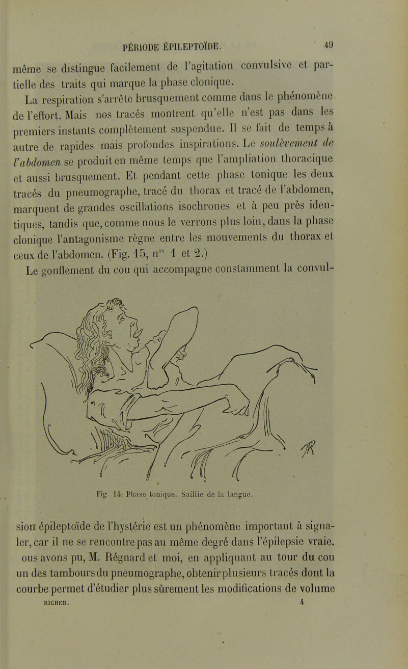 même se distingue facilement de l'agitation convulsive et par- tielle des traits qui marque la phase clonique. La respiration s'arrête brusquement comme dans le phénomène de l'effort. Mais nos tracés montrent qu'elle n'est pas dans les premiers instants complètement suspendue. Il se fait de temps à autre de rapides mais profondes inspirations. Le soulèvement de l'abdomen se produit en même temps que l'ampliation thoracique et aussi brusquement. Et pendant cette phase tonique les deux tracés du pneumographe, tracé du thorax et tracé de l'abdomen, marquent de grandes oscillations isochrones et à peu près iden- tiques, tandis que, comme nous le verrons plus loin, dans la phase clonique l'antagonisme règne entre les mouvements du thorax et ceux de l'abdomen. (Fig. 15, nos 1 et 2.) Le gonflement du cou qui accompagne constamment la convul- Fig 14. Phase tonique. Saillie de la langue. sion épileptoïde de l'hystérie est un phénomène important à signa- ler, car il ne se rencontre pas au même degré dans l'épilepsie vraie, ous avons pu, M. Régnard et moi, en appliquant au tour du cou un des tambours du pneumographe, obtenir plusieurs tracés dont la courbe permet d'étudier plus sûrement les modifications de volume RICHER. 4