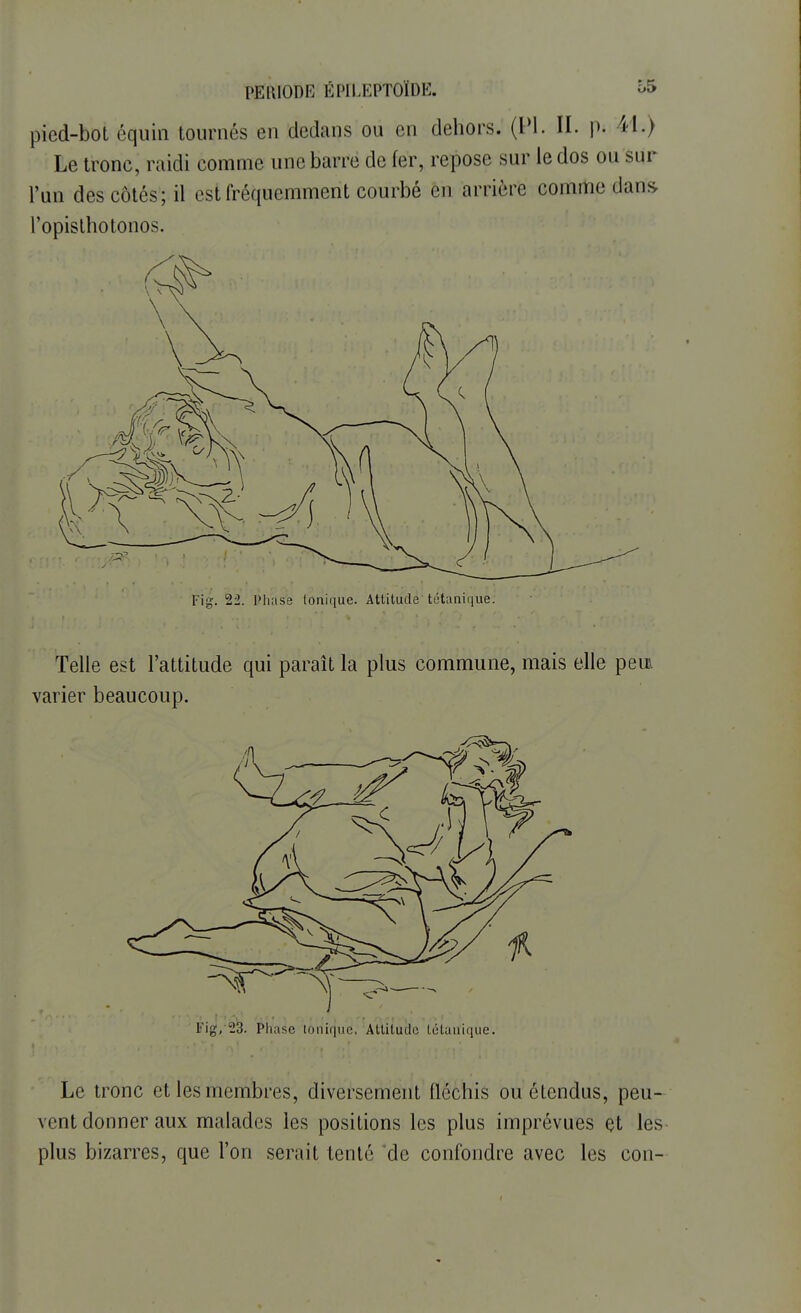 pied-bot équin tournés en dedans ou en dehors. (Pl. II. p. 41.) Le tronc, raidi comme une barre de fer, repose sur le dos ou sur l'un des côtés; il est fréquemment courbé en arrière comme dans l'opisthotonos. Fig. 22. Phase tonique. Attitude tétanique. Telle est l'attitude qui paraît la plus commune, mais elle peu varier beaucoup. Fig, 23. Phase tonique. Attitude tétanique. Le tronc et les membres, diversement fléchis ou étendus, peu- vent donner aux malades les positions les plus imprévues et les plus bizarres, que l'on serait tenté 'de confondre avec les con-