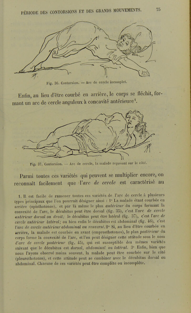 Fig. 36. Contorsion. — Arc de cercle incomplet. Enfin, au lieu d'être courbé en arrière, le corps se fléchit, for- mant un arc de cercle anguleux à concavité antérieure1. Fig. 37. Contorsion. — Arc de cercle, la malade reposant sur le côté. Parmi toutes ces variétés qui peuvent se multiplier encore, on reconnaît facilement que Yarc de cercle est caractérisé au 1. Il est facile de ramener toutes ces variétés de l'arc de cercle à plusieurs types principaux que l'on pourrait désigner ainsi : 1° La malade étant courbée en arrière (opisthotonos), et par là même le plan antérieur du corps formant la convexité de l'arc, le décubitus peut être dorsal (fig. 35), c'est Yarc de cercle antérieur dorsal ou droit; le décubitus peut être latéral (fig. 37), c'est Yarc de cercle antérieur latéral; ou bien enfin le décubitus est abdominal (fig. 46), c'est Yarc de cercle antérieur abdominal ou renversé. 2° Si, au lieu d'être courbée en arrière, la malade esl courbée en avant (emprosthotonos), le plan postérieur du corps forme la convexité de l'arc, et l'on peut désigner cette attitude sous le nom d'arc de cercle postérieur (fig. 45), qui est susceptible des mêmes variétés suivant que le décubitus est dorsal, abdominal ou latéral. 3° Enfin, bien que nous l'ayons observé moins souvent, la malade peut être courbée sur le côté (pleurothotonos), et cette attitude peut se combiner avec le décubitus dorsal ou abdominal. Chacune de ces variétés peut être complète ou incomplète.