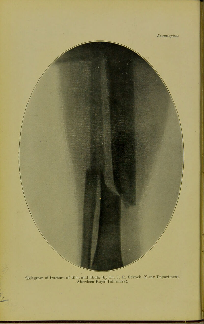 Frontispiece Skiagram of fracture oE tibia and fibula (by Dr. J. K. Lcvacl<, X-ray Department. Aberdeen Royallnfirnuiry).