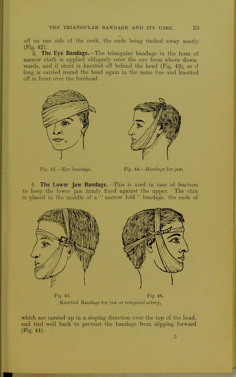 off on one side of the neck, the ends being tucked away neatly (Fig. 42). 3. The Eye Bandage.—The triangular bandage in the form of narrow cloth is applied obliquely over the eye fi'om above down- wards, and if short is knotted off behind the head (Fig. 43), or if long is carried round the head again in the same line and knotted off in front over the forehead. Fig. 43.—Ej-e bandage. Fig. 44.—Bandage for jaw. 4. The Lower Jaw Bandage.—-This is used in case of fracture to keep the lower jaw nrmly fixed against the upper. The chin is jjlaced in the middle of a  narrow fold  bandage, the ends of Fig. 45. Fig. 46. Knotted Bandage for jaw or temporal artery. which are carried up in a sloping direction over the top of the head, and tied well back to jjrevent the bandage from slipping forward (Fig. 44). 3