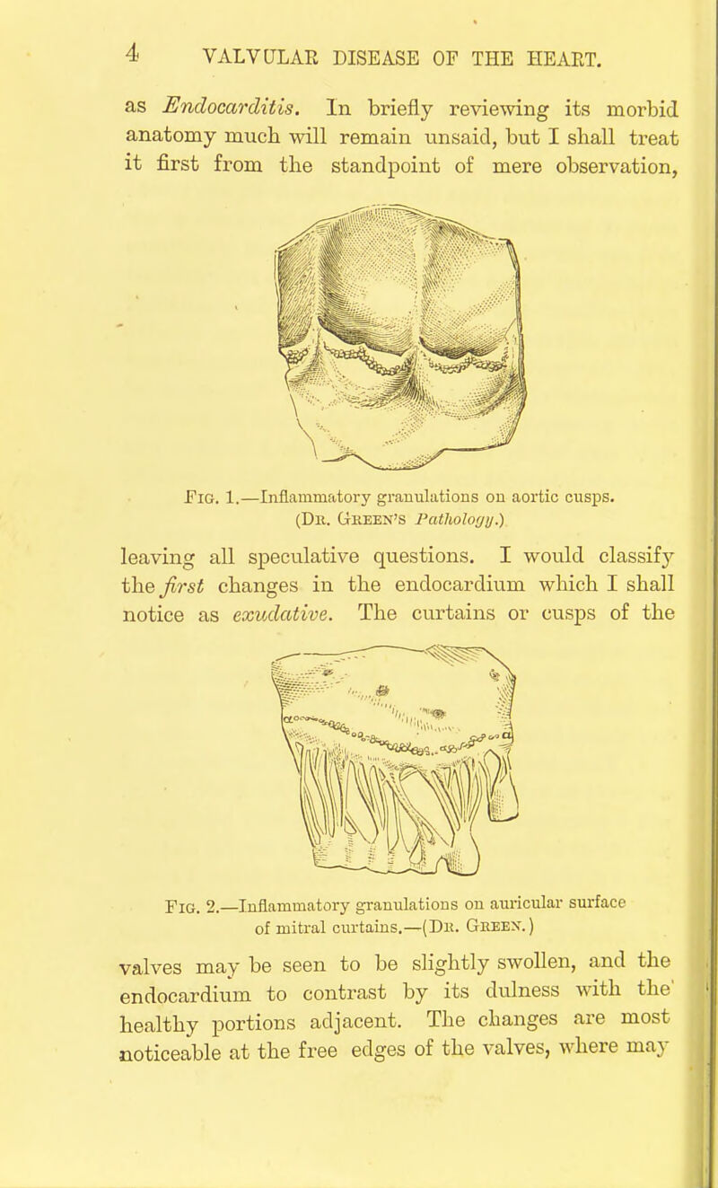 as Endocarditis. In briefly reviewing its morbid anatomy much will remain unsaid, but I shall treat it first from the standpoint of mere observation, Pig. 1.—Inflammatory granulations on aortic cusps. (Dlt. GrKEEN'S Patliology.) leaving all speculative questions. I would classify the first changes in the endocardium which I shall notice as exudative. The curtains or cusps of the Fig. 2.—Inflammatory granulations on auricular surface of mitral curtains.—(Dh. Geeex. ) valves may be seen to be slightly swollen, and the endocardium to contrast by its dulness with the' healthy portions adjacent. The changes are most noticeable at the free edges of the valves, where may