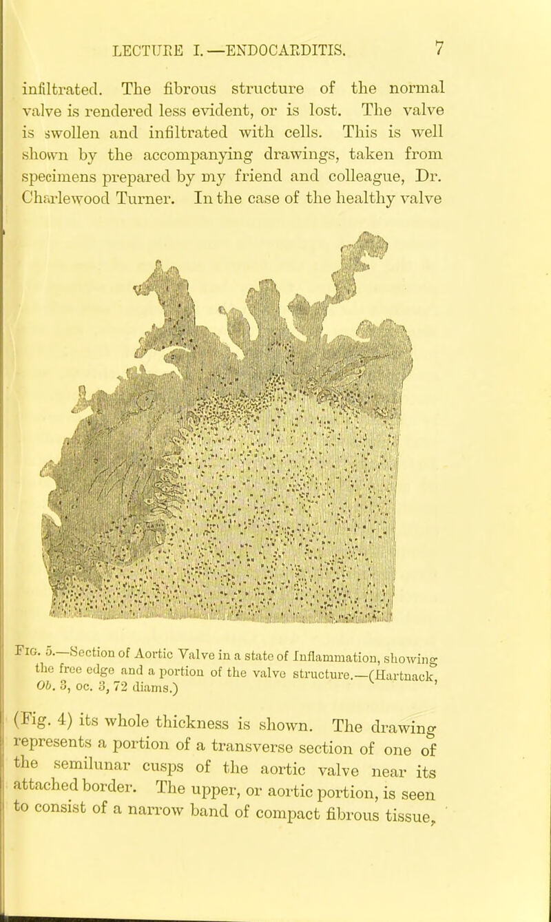 infiltrated. The fibrous structure of the normal valve is rendered less evident, or is lost. The valve is swollen and infiltrated with cells. This is well shown by the accompanying drawings, taken from specimens prepared by my friend and colleague, Dr. Charlewood Turner. In the case of the healthy valve .i ff ■<'>» mm* »V J t 1 Aw.T, Fig. 5.—Section of Aortic Valve in a state of Inflammation, showing the free edge and a portion of the valve structure.—(Hartnack Ob. 3, oc. 3, 72 diams.) ' (Fig. 4) its whole thickness is shown. The drawing represents a portion of a transverse section of one of the semilunar cusps of the aortic valve near its attached border. The upper, or aortic portion, is seen to consist of a narrow band of compact fibrous tissue,