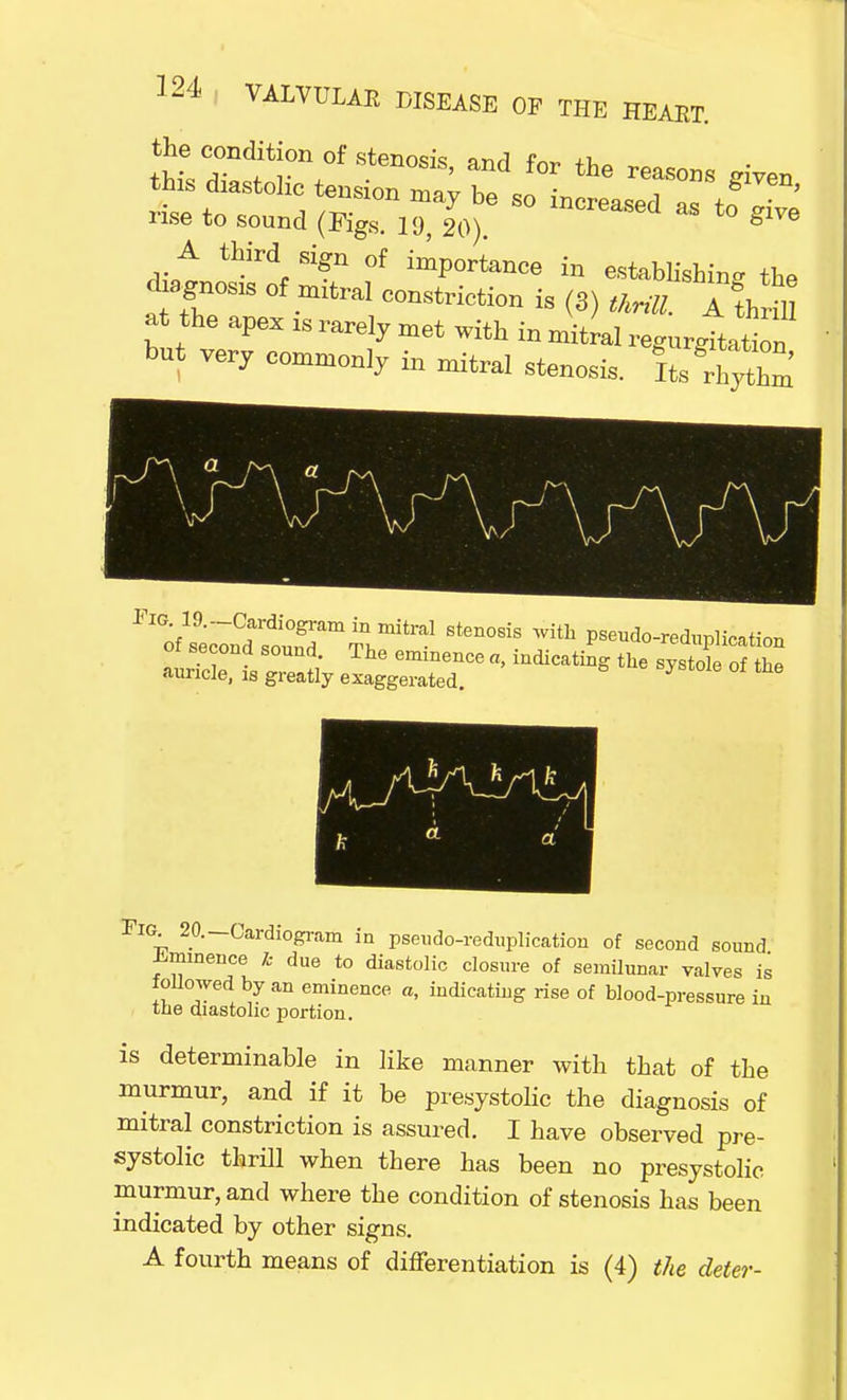 the condition of stenosis, and for the reasons given this diastolic tension may be so increased « \ rise to sound (Figs. 19, 20). ln°reased as to give A third sign of importance in establishing the dgnosis of mitral constriction is (3) thrill. A1h H at the apex is rarely met with in mitral regurgitation but very commonly in mitral stenosis, fts^ythm Fl oAt;n°dtiTdamTritral Sten°8iS With Pse^o-redUplication or second sound. The eminence a, indicating the systole of the auricle, is greatly exaggerated. J 6 rv kUa * a • 20--Cardiogram in pseudo-reduplication of second sound imminence k due to diastolic closure of semilunar valves is followed by an eminence a, indicating rise of blood-pressure in the diastolic portion. is determinable in like manner with that of the murmur, and if it be presystolic the diagnosis of mitral constriction is assured. I have observed pre- systolic thrill when there has been no presystolic murmur, and where the condition of stenosis has been indicated by other signs. A fourth means of differentiation is (4) the deter-