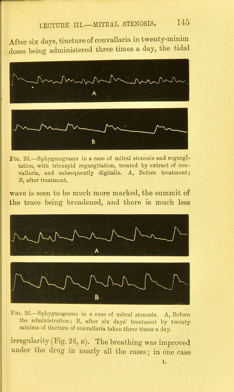 After six days, tincture of convallaria in twenty-minim doses being administered three times a day, the tidal J A B Pig. 25.—Sphygrnograms in a case of mitral stenosis and regurgi- tation, with tricuspid regurgitation, treated by extract of con- vallaria, and subsequently digitalis. A, Before treatment; B, after treatment. wave is seen to be much more marked, the summit of the trace being broadened, and there is much less Fig. 2G.—Sphygmograms in a case of mitral stenosis. A, Beforo the administration; B, after six days' treatment by twenty minims of tincture of convallaria taken three times a day. irregularity (Fig. 2 6, b). The breathing was improved under the drug in nearly all the cases; in One case L