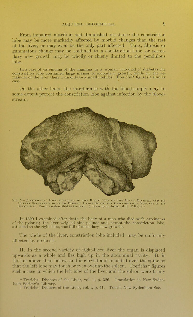 From impaired nutrition, and diminished resistance the constriction lobe may be more markedly affected by morbid changes than the rest of the liver, or may even be the only part affected. Thus, fibrosis or gummatous change may be confined to a constriction lobe, or secon- dary new growth may be wholly or chiefly limited to the pendulous lobe. In a case of carcinoma of the mamma in a woman who died of diabetes tlie constriction lobe contained large masses of secondary growth, while in the re- mainder of the liver there were only two small nodules. Frerichs* figures a similar case On the other hand, the interference with the blood-supply may to some extent protect the constriction lobe against infection by the blood- stream. FlO. 5.—CONSTRUTIOX LoitU ATTACHED TO TllH RIGHT LOBE OF THE LiVKR, DiVIUED, AND ns Halves Skpabated so as to Display Large Secondarv Carcinomatous Nodules in ns Suii.STAN( E. I''i'()in ciise descrihed in tlic lo.xl. (Drawn by 1.. Jones, M.B., F.R.C.S.) In 1S90 I examined after death the Ijody of a man who died with carcinoma of the pylorus; the liver weighed nine pounds and, except the constriction lobe, attached to the right lobe, was full of secondary new growths. The whole of the liver, constriction IoIjc included, may be uniformly affected by cirrhosis. II. In the second variety of tight-laced liver the organ is displaced upwards as a whole and lies high up in the abdominal cavit3^ It is thicker above than below, and is curved and moulded over the spine so that the left lobe may touch or even overlap the spleen. Frerichs f figures such a case in which the left lolic of the liver and the spleen were firmly * Frericlis: Diseases of the Liver, vol. ii, p. 326. Translation in New Syden- ham Society's J>il)rary. t Frerichs: Diseases of the i/n-er, vol. i, p. 41. Transl. New Sydenham Soc.