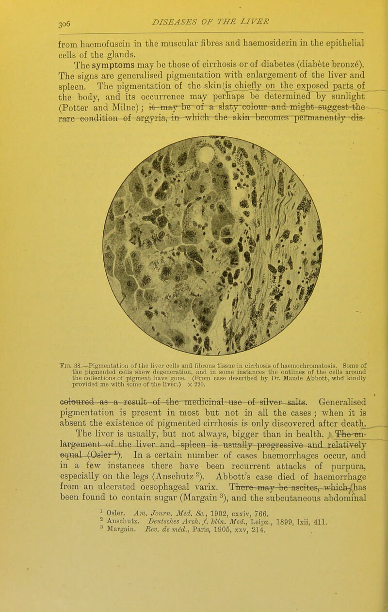 from haemofuscin in the muscular fibres and haemosiderin in the epithelial cells of the glands. The symptoms may be those of cirrhosis or of diabetes (diabete bronzd). The signs are generalised pigmentation with enlargement of the liver and spleen. The pigmentation of the skin (is chiefly on the exposed parts of the body, and its occurrence may perEaps be determined by simlight (Potter and Milne); tt-may-bB-of a-slaty-colour and might-suggest the rare condition of argyria, in which the skin becomes permanently dis- Fio. 38.—Pigmentation of the liver cell.s and fibrous tissue in cirrhosis of haemochromatosis. Some of the pigmented cells shew degeneration, and in some instances the outlines of the cells around the collections of pigment have gone. (From case described by Dr. Maude Abbott, wh<J kindly provided me with some of the liver.) x 220. celt»aged aa a rocult--of-the-mediciTial-use-of- silvei—^ialts. Generalised pigmentation is present in most but not in all the cases ; when it is absent the existence of pigmented cirrhosis is only discovered after death. The liver is usually, but not always, bigger than in health. ; The-^- lftr-gem6Ht--of-4;heJi5i6c--and---spleen--i6---usually^-progressiv6 -and^rdatively equaL-(-Osler^). In a certain number of cases haemorrhages occur, and in a few instances there have been recurrent attacks of purpura, especially on the legs (Anschutz 2). Abbott's case died of haemorrhage from an ulcerated oesophageal varix. There may be ascfte6,-which.p(has been found to contain sugar (Margain and the subcutaneous abdominal ^ Osier. Am. Jonrn. Med. Sc., 1902, cxxiv, 766.  Anscluitz. Deutsches Arch. f. Min. Med., Leipz., 1899, l.xii, 411. ^ Margain. Rev. de mid., Paris, 1905, xxv, 214.