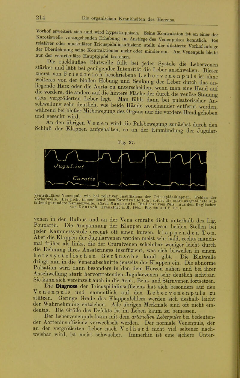 Vorhof erweitert sich und wird hypertrophisch. Seine Kontraktion ist an einer der Karotiswelle vorangehenden Erhebung im Anstiege des Venenpulses kenntUoh Bei relativer oder muskulärer Tricuspidahnsuffizienz steUt der diktierte Vorhof infolge der Uberdehnung seine Kontraktionen mehr oder minder ein. Am Venenpuls bleibt nur der ventrikuläre Hauptgipfel bestehen. Die riickläufige Blutwelle füllt bei jeder Systole die Lebervenen starker und laßt bei genügender Intensität die Leber anscbweUen Dieser zuerst von Friedreich beschriebene L e b e r v e n e n p u 1 s ist ohne weiteres von der bloßen Hebung und Senkung der Leber durch das an- liegende Herz oder die Aorta zu unterscheiden, wenn man eine Hand auf die vordere, die andere auf die hintere Fläche der durch die venöse Stauung stets vergrößerten Leber legt. Man fühlt dann bei pulsatorischer An- schweUung sehr deutlich, wie beide Hände voneinander entfernt werden wahrend bei bloßer Mitbewegung des Organs nur die vordere Hand gehoben und gesenkt wird. Q 1,1 ^q übrigen Venen wird die Pulsbewegung zunächst durch den bchluß der Klappen aufgehalten, so an der Einmündung der Jugular- Fig. 37. vn^w ii'^^'^X®^?!^-'^'^ relativer Insuffizienz der Triouspidalklappen. Fehlen der lu^f^Z} ^- A^^^^'t?'^^ deutlichen Karotiswelle folgt sofort die stark ausgebildete auf- fallend gerundete Kammerwelle. (Nach Mackenzie, Die Lehre vom Puls. Aus dem Englischen von Deutsch. Frankfurt a. M. 1904. Fig. 221 auf S. 202.) venen in den Bulbus und an der Vena cruralis dicht unterhalb des Lig. Poupartii. Die Anspannung der Klappen an diesen beiden Stellen bei jeder Kammersystole erzeugt oft einen kurzen, klappenden Ton. Aber die Klappen der Jugularvenen werden meist sehr bald, rechts manch- nial früher als links, die der Cruralvenen scheinbar weniger leicht durch die Dehnung ihres Ansatzringes insuffizient, was sich bisweilen in einem herzsysto Ii sehen Geräusche kund gibt. Die Blutwelle dringt nun in die Venenabschnitte jenseits der Klappen ein. Die abnorme Pulsation wird dann besonders in den dem Herzen nahen und bei ihrer Anschwellung stark hervortretenden Jugularvenen sehr deutUch sichtbar. Sie kann sich vereinzelt auch in die Arm-, Bein- und Stirnvenen fortsetzen. Die Diagnose der Tricuspidahnsuffizienz hat sich besonders auf den Venenpuls und namentlich auf den Lebervenenpuls zu stützen. Geringe Grade des Klappenfehlers werden sich deshalb leicht der Wahrnehmung entziehen. Alle übrigen Merkmale sind oft nicht ein- deutig. Die Größe des Defekts ist im Leben kaum zu bemessen. Der Lebervenenpuls kann mit dem arteriellen Leberpvlse bei bedeuten- der Aorteninsuffizienz verwechselt werden. Der normale Venenpuls, der an der vergrößerten Leber nach V o 1 h a r d nicht viel seltener nach- weisbar wird, ist meist schwächer. Immerhin ist eine sichere Unter-