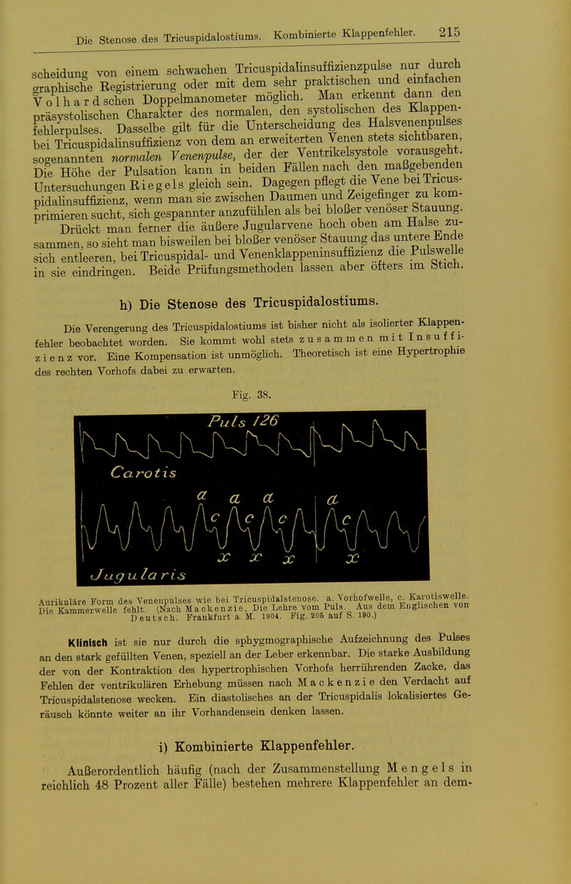 scheiduna von einem schwachen Tricuspidalinsuffizienzpulse nur dmch apÄ E^^^^^^ oder mit dem sehr praktischen und anfachen Volhard sehen Doppehnanometer möghch. Man erkennt dann den präsystoHschen Charakter des normalen, den systohschen des Klappen- FehVrpulses. Dasselbe gilt für die Unterscheidung des Hal^venenpul^^^ bei Tricuspidalinsuffizienz von dem an erweiterten Venen stets sichtbaren, sogenannten normalen Venenpulse, der der Ventrikelsystole vorausgeh^ Die Höhe der Pulsation kann in beiden FaUen nach den maßgebenden Untersuchungen Riegels gleich sein. Dagegen pflegt die Vene bei Tricus- pidahnsuffizienz, wenn man sie zwischen Daumen und Zeigefinger zu kom- primieren sucht, sich gespannter anzufühlen als bei bloßer venöser Stauung. Drückt man ferner die äußere Jugularvene hoch oben am Halse zu- sammen, so sieht man bisweilen bei bloßer venöser Stauung das untere Ende sich entleeren, bei Tricuspidal- und Venenklappemnsuffizienz die Pulswelle in sie eindringen. Beide Prüfungsmethoden lassen aber öfters im btich. h) Die Stenose des Tricuspidalostiums. Die Verengerung des Tricuspidalostiums ist bisher nicht als isoUerter Klappen- fehler beobachtet worden. Sie kommt wohl stets zusammenmitlnsuffi- z i e n z vor. Eine Kompensation ist unmöghch. Theoretisch ist eine Hypertrophie des rechten Vorhofs dabei zu erwarten. Fig. 38. Aurikuläre Form des Veneupulses wie bei Tricuspidalstenose. a. Vorliofwelle, c^ Karotiswelle^ oL KammerweUe fehlt. (Nach Mackenzie, Die Lehre vom Puls. Aus dem Englischen von Deutsch. Frankfurt a. M. 1904. Fig. 205 auf S. 190.) Klinisch ist sie nur durch die sphygmographische Aufzeichnung des Pulses an den stark gefüllten Venen, speziell an der Leber erkennbar. Die starke Ausbildung der von der Kontraktion des hypertrophischen Vorhofs herrührenden Zacke, das Fehlen der ventrikulären Erhebung müssen nach Mackenzie den Verdacht auf Tricuspidalstenose wecken. Ein diastohsches an der Tricuspidalis lokalisiertes Ge- räusch könnte weiter an ihr Vorhandensein denken lassen. i) Kombinierte Klappenfehler. Außerordentlich häufig (nach der Zusammenstellung Meng eis in reichlich 48 Prozent aller Fälle) bestehen mehrere Klappenfehler an dem-