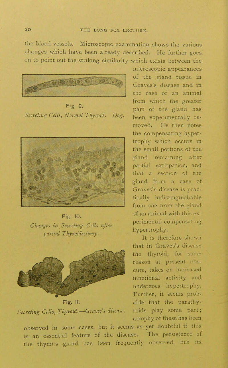 Fig. 9. Secreting Cells, Normal Thyroid. Do2. the blood vessels. Microscopic examination shows the various changes which have been already described. He further goes on to point out the striking similarity which exists between the microscopic appearances of the gland tissue in Graves's disease and in the case of an animal from which the greater part of the gland has been experimentally re- moved. He then notes the compensating hyper- trophy which occurs in the small portions of the gland remaining after partial extirpation, and that a section of the gland from a case of Graves's disease is prac- tically indistinguishable from one from the gland of an animal with this ex- perimental compensating hypertrophy. It is therefore shown that in Graves's disease the thyroid, for some reason at present obs- cure, takes on increased functional activity and undergoes hypertrophy. Further, it seems prob- able that the parathy- roids play some part; atrophy of these has been observed in some cases, but it seems as yet doubtful if this is an essential feature of the disease. The persistence of the thymus gland has been frequently observed, but its Fig. 10. Changes in Secreting Cells after partial Thyroidectomy. Fig. 11. Secreting Cells, Thyroid.—Graves's disease.