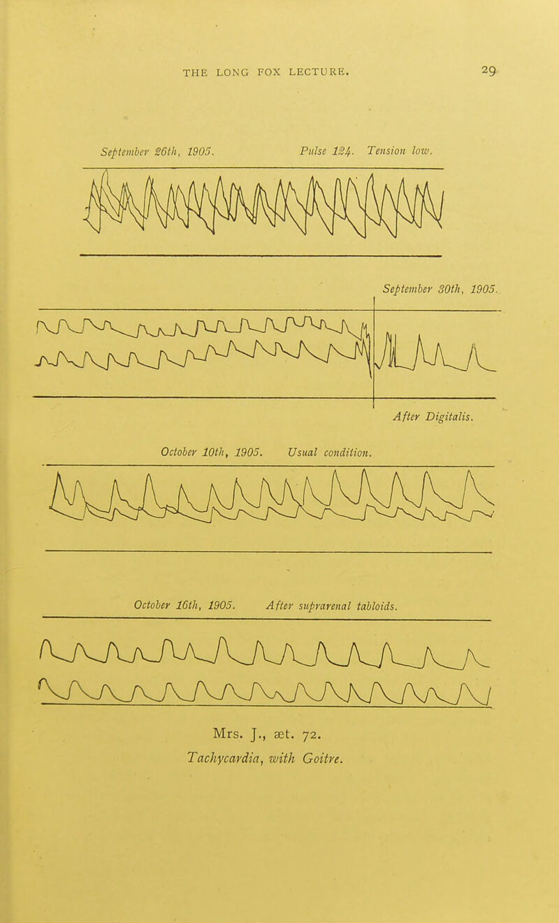 September 26th, 1905. Pulse 134. Tension loiv. September 30th, 1905. After Digitalis. October lOth, 1905. Usual condition. October 16th, 1905. After suprarenal tabloids. Mrs. J., set. 72. Tachycardia, with Goitre.