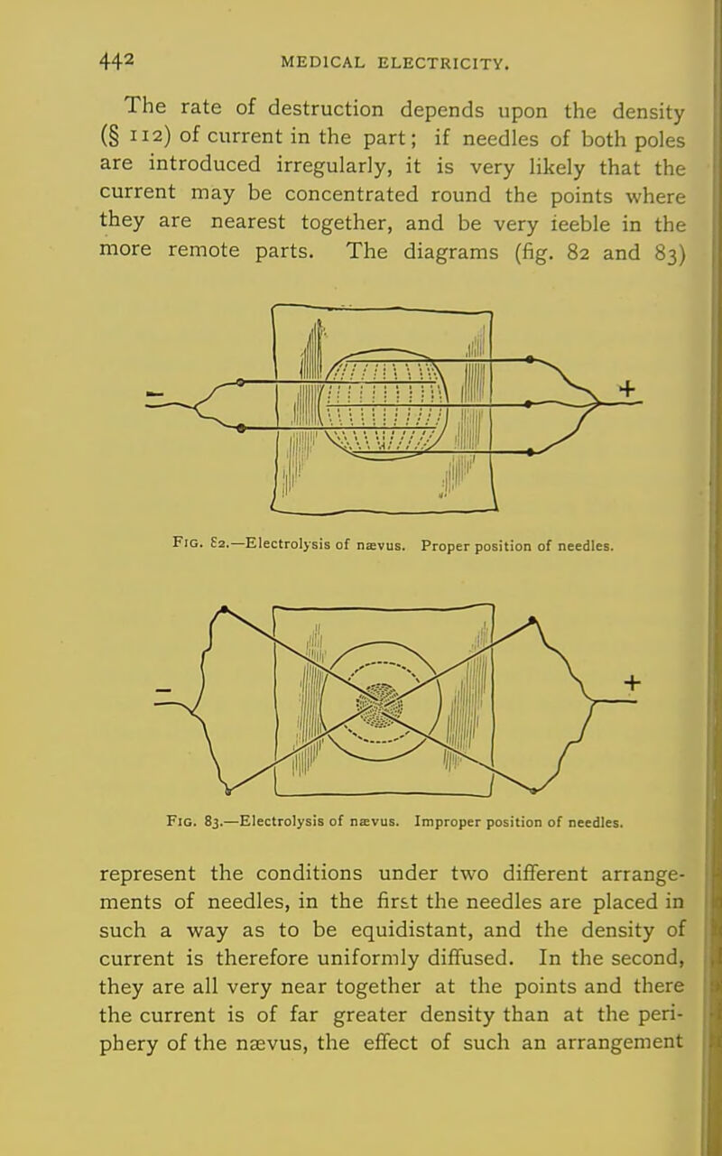 The rate of destruction depends upon the density (§ 112) of current in the part; if needles of both poles are introduced irregularly, it is very likely that the current may be concentrated round the points where they are nearest together, and be very ieeble in the more remote parts. The diagrams (fig. 82 and 83) Fig. 83.—Electrolysis of njEvus. Improper position of reedles. represent the conditions under two different arrange- ments of needles, in the first the needles are placed in such a way as to be equidistant, and the density of current is therefore uniformly diffused. In the second, they are all very near together at the points and there the current is of far greater density than at the peri- phery of the nsevus, the effect of such an arrangement