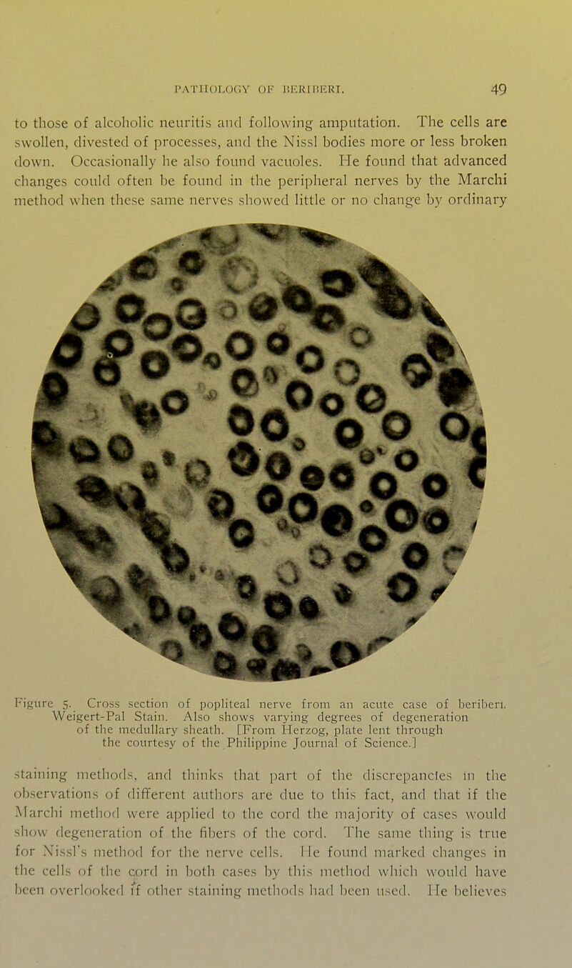 to those of alcoholic neuritis and following amputation. The cells are swollen, divested of processes, and the Nissl bodies more or less broken down. Occasionally he also found vacuoles. He found that advanced changes could often be found in the peripheral nerves by the Marchi method when these same nerves showed little or no change by ordinary »• O ®0 o^-io^ i Figure 5. Cross section of popliteal nerve from an acute case of beriberi. Weigert-Pal Stain. Also shows varying degrees of degeneration of the medullary sheath. [From Herzog, plate lent through the courtesy of the Philippine Journal of Science.] staining methods, and thinks that part of the discrepancies in the observations of different authors are due to this fact, and that if the Marchi method were applied to the cord the majority of cases would show degeneration of the fibers of the cord. The same thing is true for Nissl's method for the nerve cells. I le found marked changes in the cells of the cord in both cases by this method which would have been overlooked if other staining methods had been used. He believes