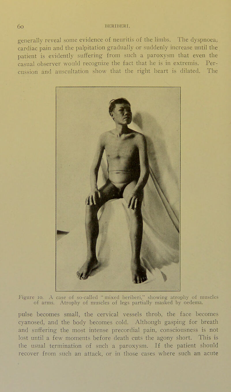 generally reveal some evidence of neuritis of the limbs. The dyspnoea; cardiac pain and the palpitation gradually or suddenly increase until the. patient is evidently suffering from such a paroxysm that even the casual observer would recognize the fact that he is in extremis. Per- cussion and auscultation show that the right heart is dilated. The Figure lo. A case of so-called  mixed beril.ieri, sliowing atrophy of muscles of arms. Atrophy of muscles of legs partially masked by oedema. pulse becomes small, the cervical vessels throb, the face becomes cyanosed, and the body becomes cold. Although gasping for breath and suffering- the most intense precordial pain, consciousness is not lost until a few moments before death cuts the agony short. This is the ustial termination of sucli a paroxysm. If the patient should recover from such an attack, or in those cases where such an acute