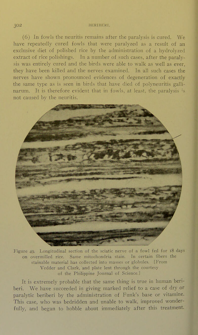 (6) In fowls the neuritis remains after the paralysis is cured. We have repeatedly cured fowls that were paralyzed as a result of an exclusive diet of polished rice by the administration of a hydrolyzed extract of rice polishings. In a number of such cases, after the paraly- sis was entirely cured and the birds were able to walk as well as ever, they have been killed and the nerves examined. In all such cases the nerves have shown pronounced evidences of degeneration of exactly the same type as is seen in birds that have died of polyneuritis galli- narum. It is therefore evident that in fowls, at least, the ])aralysis 's not caused by the neuritis. Figure 49. Longitudinal section of the viatic nerve of a fowl fed for 18 days on overmilled rice. Same mitochondria stain. In certain fibers the stainable material has collected into masses or globules. [From Vedder and Clark, and plate lent through the courtesy of the Philippine Journal of Science.] It is extremely probable that the same thing is true in human beri- beri. We have succeeded in giving marked relief to a case of dry or paralytic beriberi by the administration of Funk's base or vitamine. This case, who was bedridden and unable to walk, improved wonder- fully, and began to hobble about immediately after this treatment.