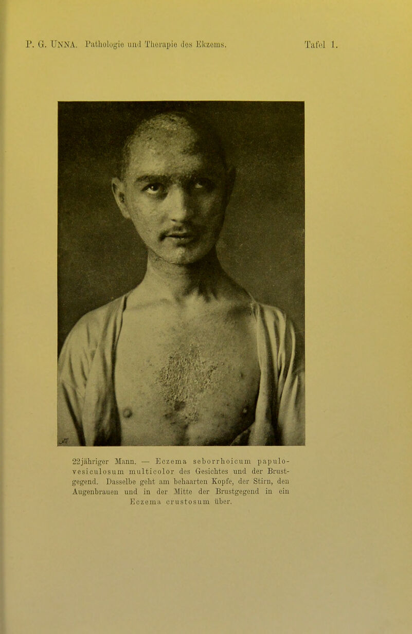vesiculosum multieolor des Gesichtes und der Brust- gegend. Dasselbe geht am behaarten Kopfe, der Stirn, den Augenbrauen und in der Mitte der Brustgegend in ein Eczema crustosum über.
