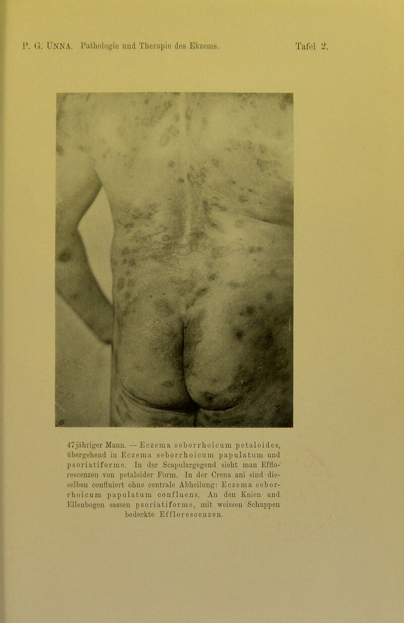 47jähnger Maun. — Eczema seborrhoicum petaloides, übergehend iu Eczema seborrboicum papulatum uud psoriatiforme. In der Scapulargegend siebt mau Efflo- rescenzeii von petaloider Form. In der Crena ani sind die- selben eonfluiert obne centrale Abbeihmg: Eczema sebor- rboicum papulatum confluens. An den Knien uud Ellenbogen sassen psoriatiforme, mit weissen Schuppen bedeckte Efflorescenzen.