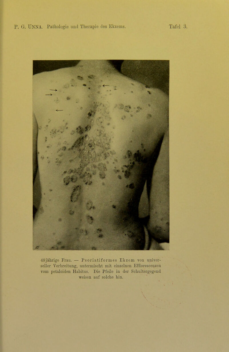 48jährige Frau. — Psoriatiformes Ekzem vou univer- seller Verbreitung, untermischt mit einzelneu Efflorescenzen vom petaloiden Habitus. Die Pfeile in der Schultergegeud weisen auf solche hin.