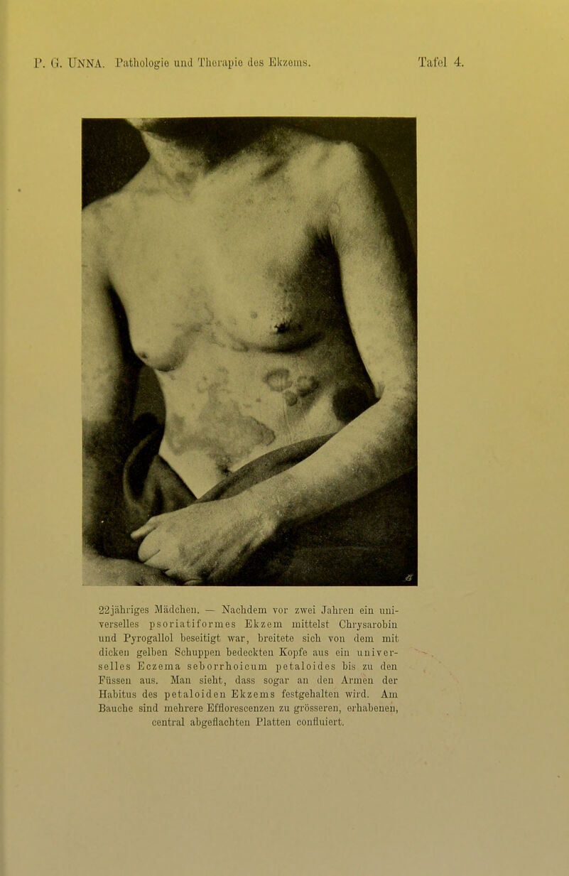 22jähriges Mädchen. — Nachdem vor zwei Jahren ein uni- verselles psoriatiformes Ekzem mittelst Chrysarobiu und Pyrogallol beseitigt war, breitete sich von dem mit dicken gelben Schuppen bedeckten Kopfe aus ein univer- selles Eczema seborrhoicum petaloides bis zu den Füssen aus. Man sieht, dass sogar an den Armen der Habitus des petaloiden Ekzems festgehalten wird. Am Bauche sind mehrere Efflorescenzen zu grösseren, erhabenen, central abgeflachten Platten confluiert.