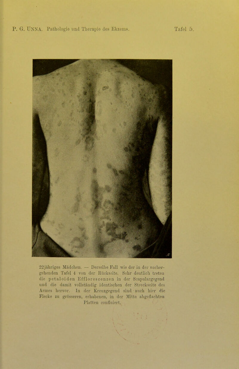22jähnges Mädchen. — Derselbe Fall wie der in der vorher- gehenden Tafel 4 von der Rückseite. Sehr deutlich treten die petaloiden Efflorescenzen in der Scapulargegend und die damit vollständig identischen der Streckseite des Armes hervor. In der Krenzgegend sind • auch hier die Flecke zu grösseren, erhabenen, in der Mitte abgeflachten Platten confluiert.