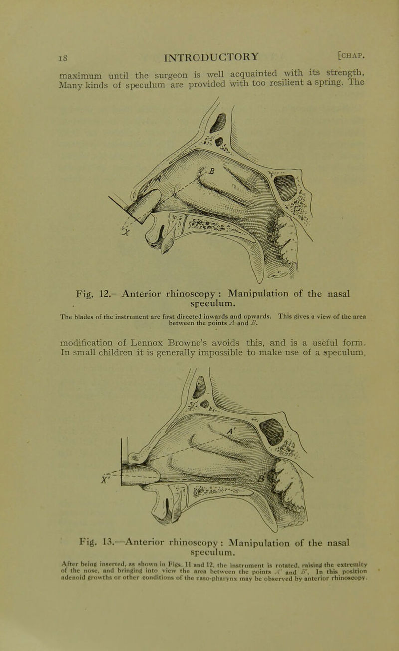 maximum imtil the surgeon is well acquainted with its strength. Many kinds of speculum are provided with too resilient a spnng. The Fig. 12.—Anterior rhinoscopy : Manipulation of the nasal speculum. The blades of the instrument are first directed inwards and upwards. This gives a view of the area between the points A and -B. modification of Lennox Browne's avoids this, and is a useful form. In small children it is generally impossible to make use of a speculum. Fig. 13.—Anterior rhinoscopy : Manipulation of the nasal speculum. After being inserted, as shown in Figs. 11 and 12. the instrument is rotated, raising the extremity of the nose, and bringing into view the area between the points .1' and />'. In this position adenoid growths or other conditions of the naso-pharynx may be observed by anterior rhinoscopy.