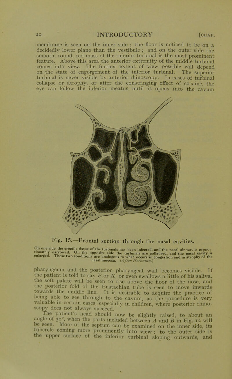 membrane is seen on the inner side ; the floor is noticed to be on a decidedly lower plane than the vestibule ; and on the outer side the smooth, round, red mass of the inferior turbinal is the most prominent feature. Above this area the anterior extremity of the middle turbinal comes into view. The further extent of view possible will depend on the state of engorgement of the inferior turbinal. The superior turbinal is never visible by anterior rhinoscopy. In cases of turbinal collapse or atrophj'', or after the constringing effect of cocaine, the eye can follow the inferior meatus until it opens into the cavum Fig. 15.—Frontal section through the nasal cavities. On one side the erectile tissue of the turbinals has been injected, and the nasal air-way is propor tionately narrowed. On the opposite side the turbinals are collapsed, and the nasal cavity is enlarged. Ihese two conditions are analogous to what occurs in congestion and in atrophy of the nasal mucosa. (After Hcnnann.) pharyngeum and the posterior pharyngeal wall becomes visible. If the patient is told to say E or K, or even swallows a Uttle of his saliva, the soft palate will be seen to rise above the floor of the nose, and the posterior fold of the Eustachian tube is seen to move inwards towards the middle line. It is desirable to acquire the practice of bcmg able to see through to the cavum, as the procedure is verv valuable in certain cases, especially in children, where posterior rhino- scopy docs not always succeed. The patient's head should now be slightlv raised, to about an angle of 30°, when the parts included between A and B in Fig. 12 will be seen. More of the septum can be examined on the inner side, its tubercle coming more prominentlv into view ; to the outer side is the upper surface of the inferior turbinal sloping outwards, and