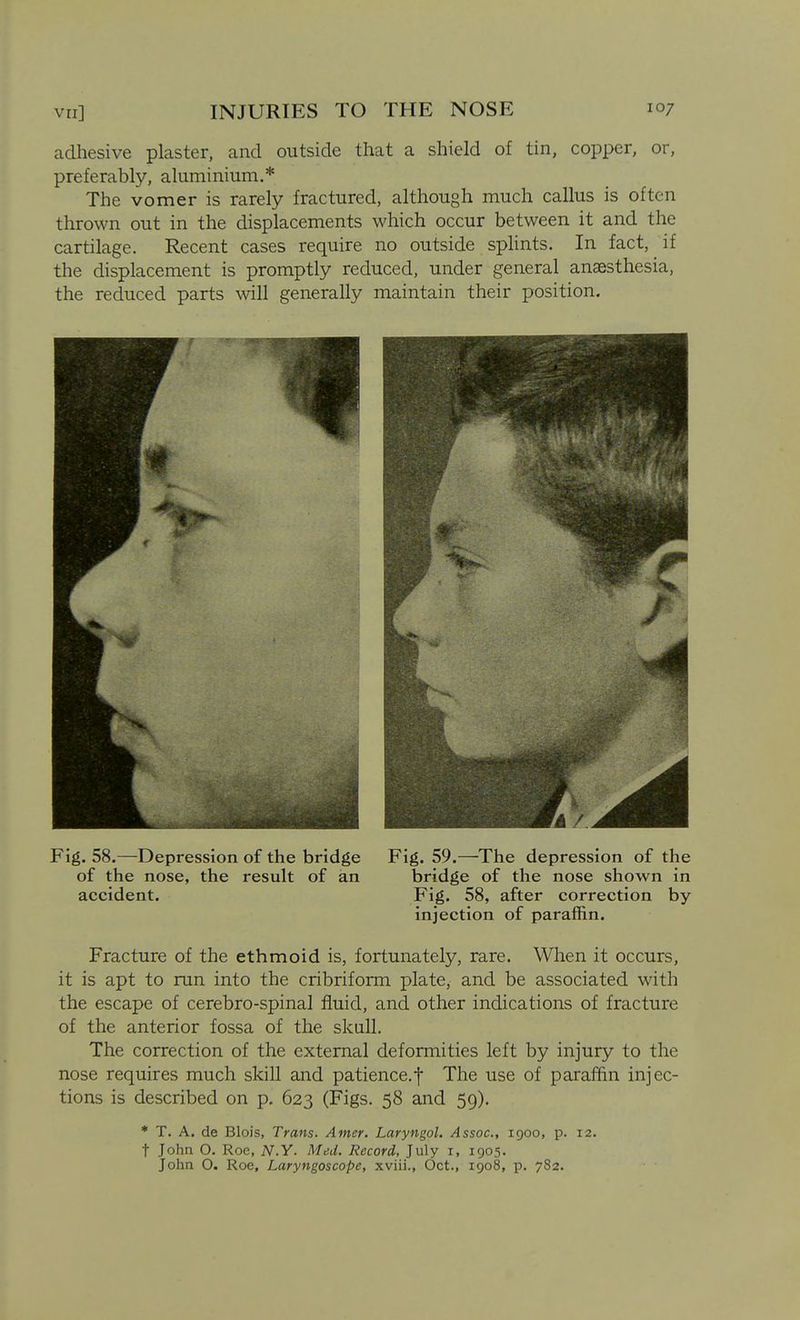 adhesive plaster, and outside that a shield of tin, copper, or, preferably, aluminium.* The vomer is rarely fractured, although much callus is often thrown out in the displacements which occur between it and the cartilage. Recent cases require no outside splints. In fact, if the displacement is promptly reduced, under general anaesthesia, the reduced parts will generally maintain their position. Fig. 58.—Depression of the bridge Fig. 59.—The depression of the of the nose, the result of an bridge of the nose shown in accident. Fig. 58, after correction by injection of paraffin. Fracture of the ethmoid is, fortunately, rare. When it occurs, it is apt to run into the cribriform plate, and be associated with the escape of cerebro-spinal fluid, and other indications of fracture of the anterior fossa of the skull. The correction of the external deformities left by injury to the nose requires much skill and patience.f The use of paraffin injec- tions is described on p. 623 (Figs. 58 and 59). * T. A. de Blois, Trans. Amer. Laryngol. Assoc., 1900, p. 12. t John O. Roc, N.Y. Med. Record, July i, 1905. John O. Roe, Laryngoscope, xviii., Oct., 1908, p. 782.