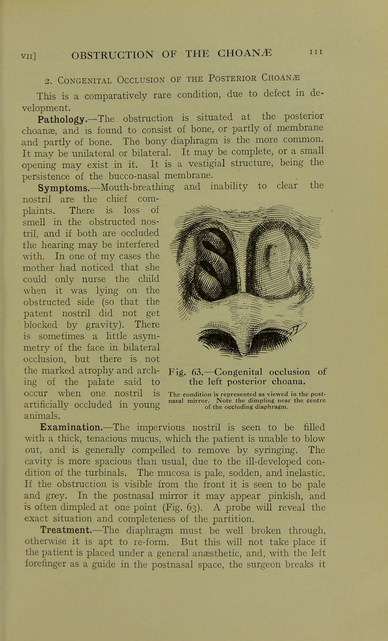 OBSTRUCTION OF THE GHOAN^ I ] I 3. Congenital Occlusion of the Posterior Cuoan^ This is a comparatively rare condition, due to defect in de- velopment. Pathology.—The obstruction is situated at the posterior choanze, and is found to consist of bone, or partly of membrane and partly of bone. The bony diaphragm is the more common. It may be unilateral or bilateral. It may be complete, or a small opening may exist in it. It is a vestigial structure, being the persistence of the bucco-nasal membrane. Symptoms.—Mouth-breathing and inability to clear the nostril are the chief com- plaints. There is loss of smell in the obstructed nos- tril, and if both are occluded the hearing may be interfered with. In one of my cases the mother had noticed that she could only nurse the child when it was lying on the obstructed side (so that the patent nostril did not get blocked by gravity). There is sometimes a little asym- metry of the face in bilateral occlusion, but there is not the marked atrophy and arch- ing of the palate said to occur when one nostril IS The condition is represented as viewed in the post- .•r • Ti 1 J 1 • nasal mirror. Note the dimpling near the centre artificially occluded m young of the occluding diaphragm, animals. Examination.—The impervious nostril is seen to be filled with a thick, tenacious mucus, which the patient is unable to blow out, and is generally compelled to remove by syringing. The cavity is more spacious than usual, due to the ill-developed con- dition of the turbinals. The mucosa is pale, sodden, and inelastic. If the obstruction is visible from the front it is seen to be pale and grey. In the postnasal mirror it may appear pinkish, and is often dimpled at one point (Fig. 63). A probe will reveal the exact situation and completeness of the partition. Treatment.—The diaphragm must be well broken through, otherwise it is apt to re-form. But this will not take place if the patient is placed under a general anjesthetic, and, with the left forefinger as a guide in the postnasal space, the surgeon breaks it Fig. 63.—Congenital occlusion of the left posterior choana.