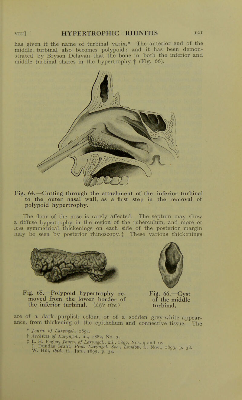 has given it the name of turbinal varix.* The anterior end of the middle. turbinal also becomes polypoid; and it has been demon- strated by Bryson Delavan that the bone in both the inferior and middle turbinal shares in the hypertrophy f (Fig. 66). Fig. 64.—Cutting through the attachment of the inferior turbinal to the outer nasal wall, as a first step in the removal of polypoid hypertrophy. The floor of the nose is rarely affected. The septum may show a diffuse hypertrophy in the region of the tuberculum, and more or less symmetrical thickenings on each side of the posterior margin may be seen by posterior rhinoscopy. | These various thickenings Fig. 65.—^Polypoid hypertrophy re- Fig. 66.—Cyst moved from the lower border of of the middle the inferior turbinal. {Life size.) turbinal. are of a dark purplish colour, or of a sodden grey-white appear- ance, from thickening of the epithelium and connective tissue. The * Journ. of Laryngol., 1894. t Archives of Laryngol, iii., 1882, No. 3. t L. H. Pegler, Journ. of Laryngol, xii., 1897, Nos. 9 and 12. J. Dundas Grant, Proc. Laryngol Soc, London, i., Nov., 1893, p. 38. W. Hill, ibid., ii., Jan., 1895, p. 34.
