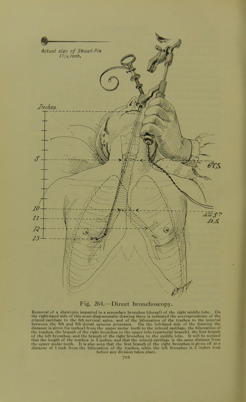 Fig. 264.—Direct bronchoscopy. Removal of a shawl-pin impacted in a secondary bronchus (dorsal) of the right middle lobe. On the right-hand side of this scmi-diogrammatic drawing there is indicated the correspondence of the cricoid cartilage to the 6th cervical spine, and of the bifurcation of the trachea to the intersal between the 4th and 5th dorsal spinous processes. On the left-hand side of the drawing the distance is given (in inches) from the upper molar teeth to the cricoid cartilage, the bifurcation of the trachea, the branch of the right bronchus to the upper lobe (cparterial branch), the first branch of the left bronchus, and the branch of the right bronchus to the middle lobe. It will be noticed that the length of the trachea is 5 inches, and that the cricoid cartilage is the same distance from the upper molar teeth. It is also seen that the first branch of the right bronchus is given off at a distance of I inch from the bifurcation of the trachea, while the left bronchus is 2 inches long before any division takes place.