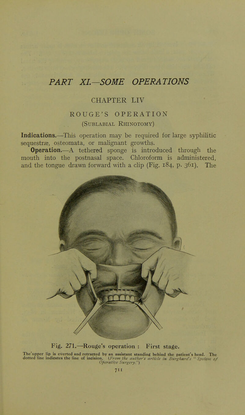 PART XL—SOME OPERATIONS CHAPTER LIV ROUGE'S OPERATION (SUBLABIAL RhINOTOMY) Indications.—This operation may be required for large syphilitic sequestrse, osteomata, or malignant growths. Operation.—A tethered sponge is introduced through the mouth into the postnasal space. Chloroform is administered, and the tongue drawn forward with a clip (Fig. 184, p. 361). The Fig. 271.—Rouge's operation : First stage. The'upper lip is everted and retracted by an assistant standing behind the patient's head. The dotted line indicates the line of incision. {From the author's article in BurghartTs System of Operative Surgery.)